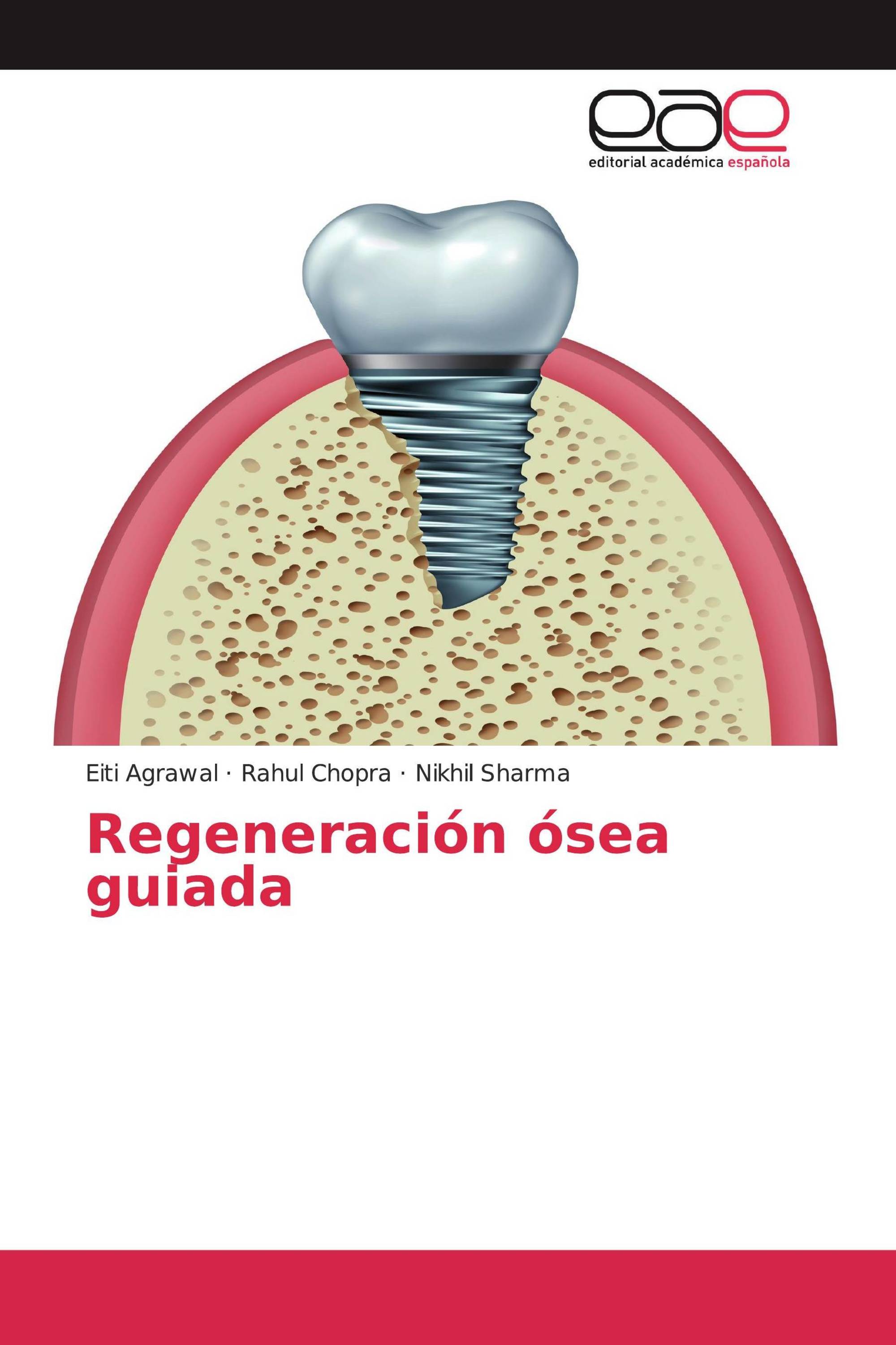 Regeneración ósea guiada