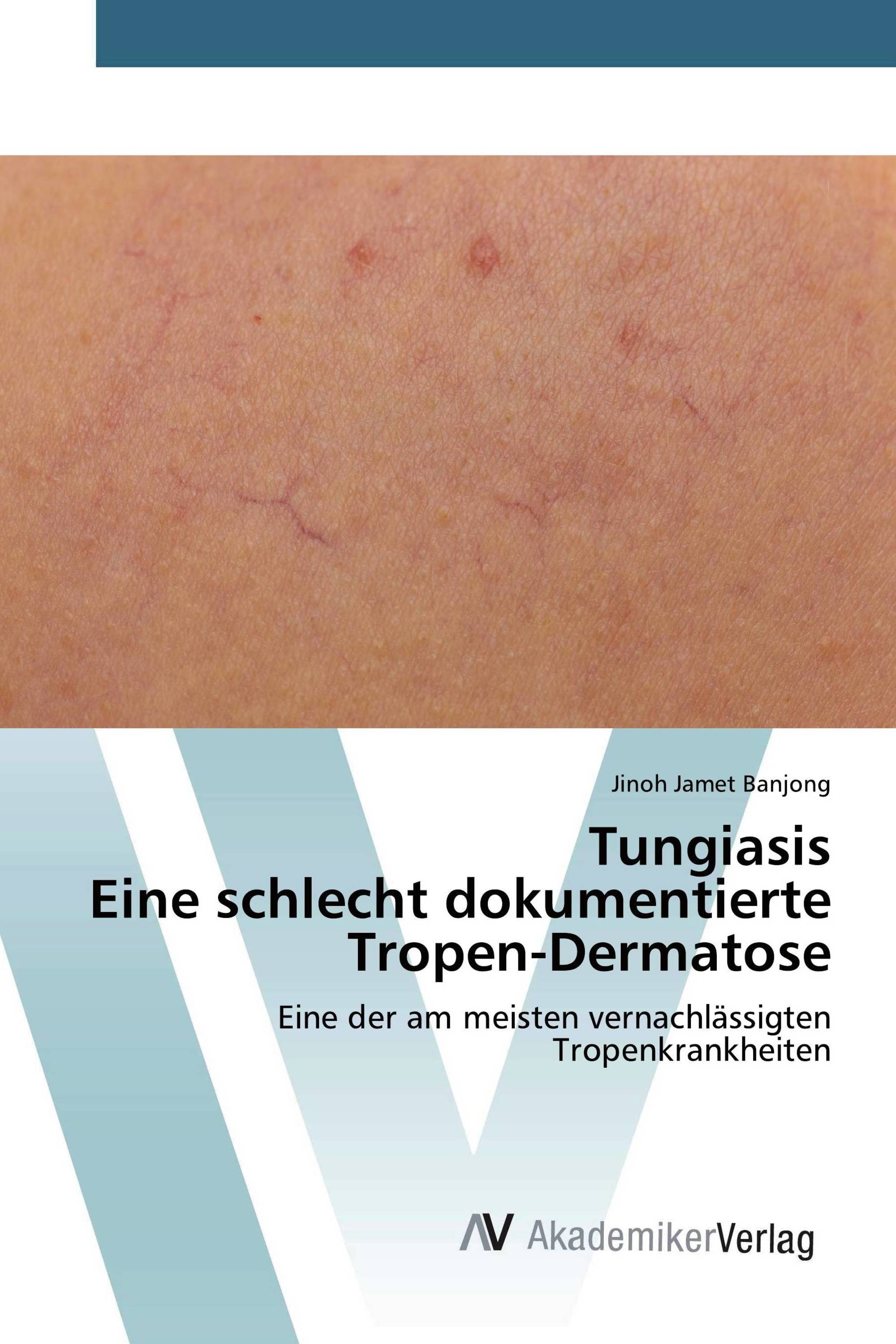 TungiasisEine schlecht dokumentierte Tropen-Dermatose