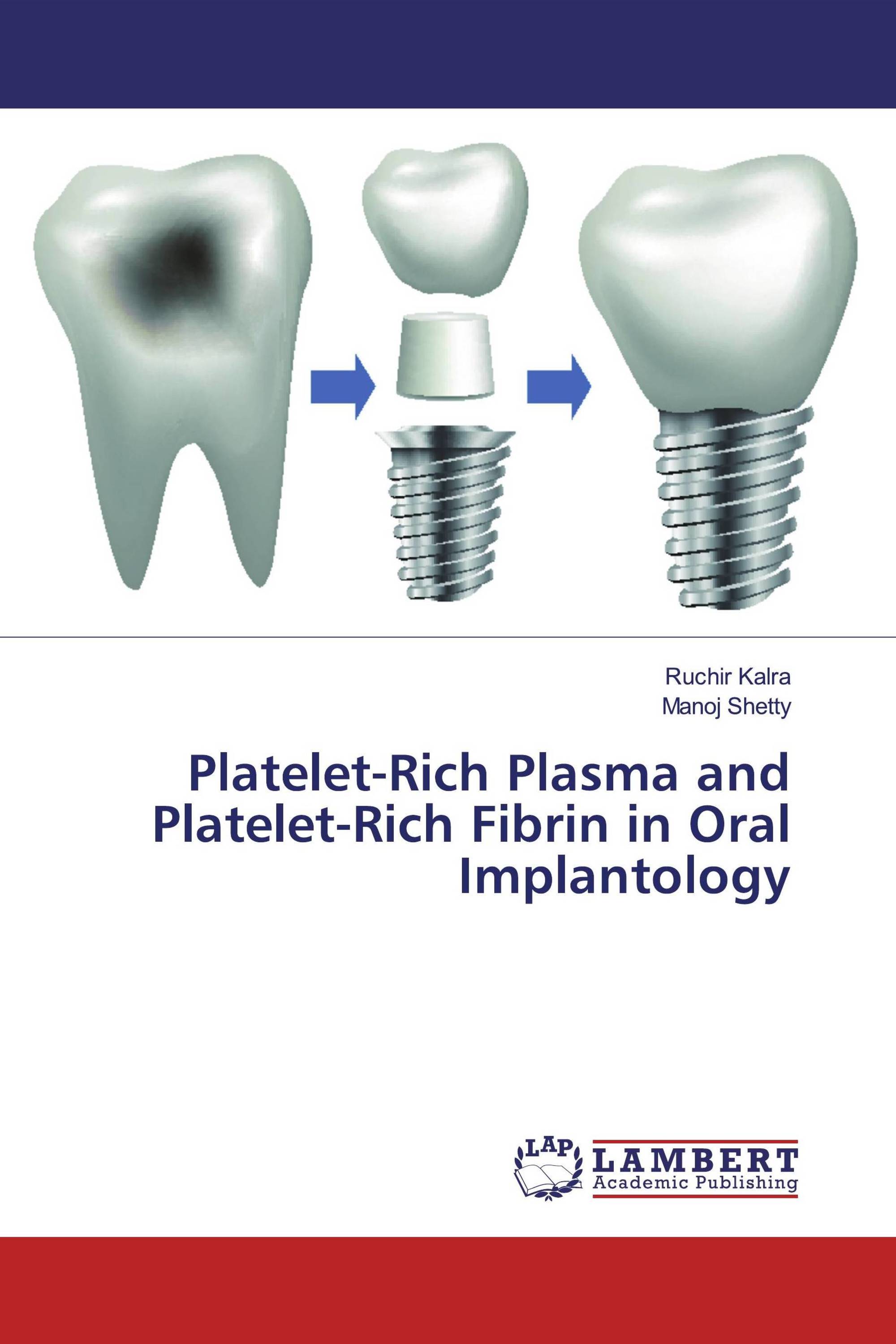 Platelet-Rich Plasma and Platelet-Rich Fibrin in Oral Implantology