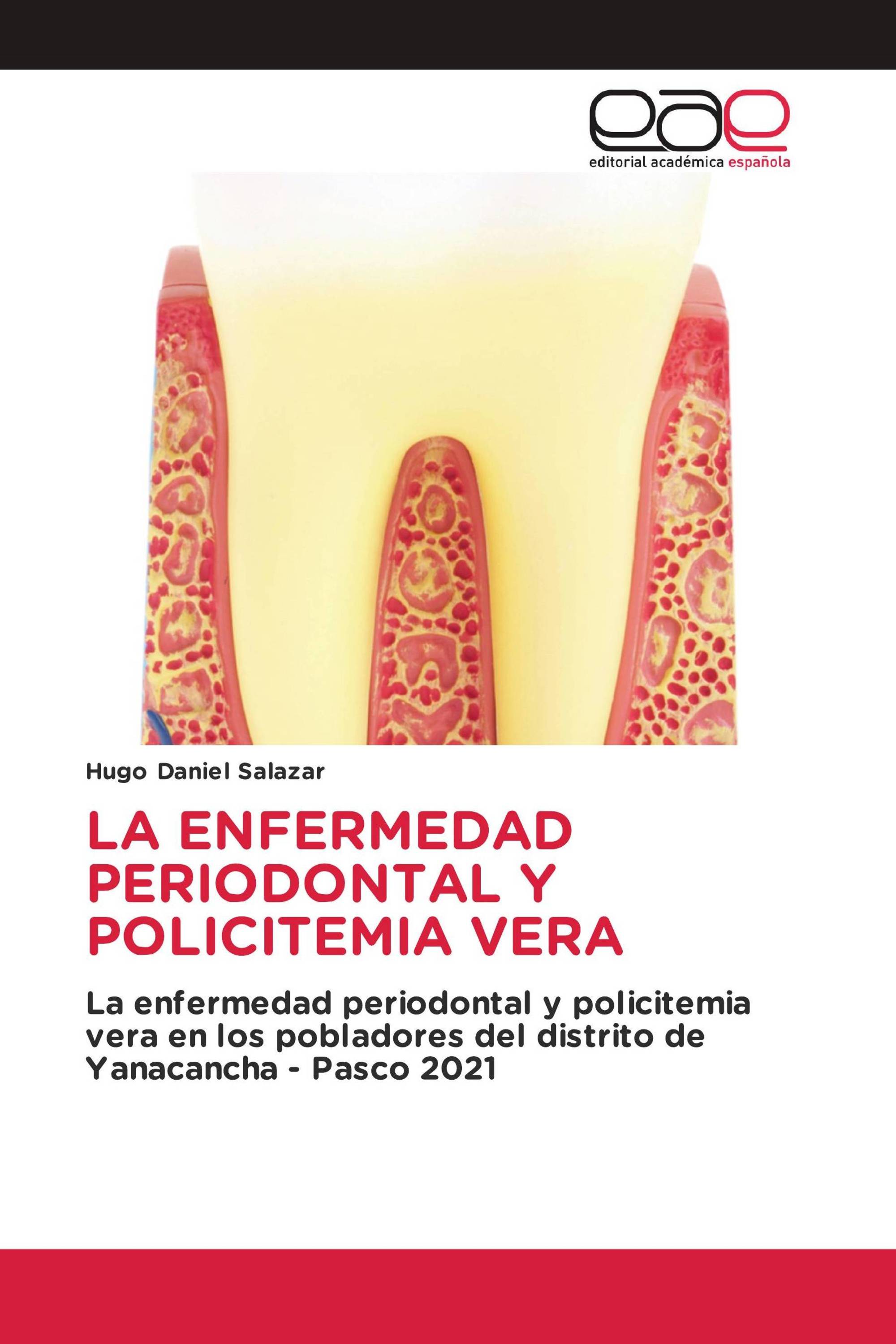 LA ENFERMEDAD PERIODONTAL Y POLICITEMIA VERA