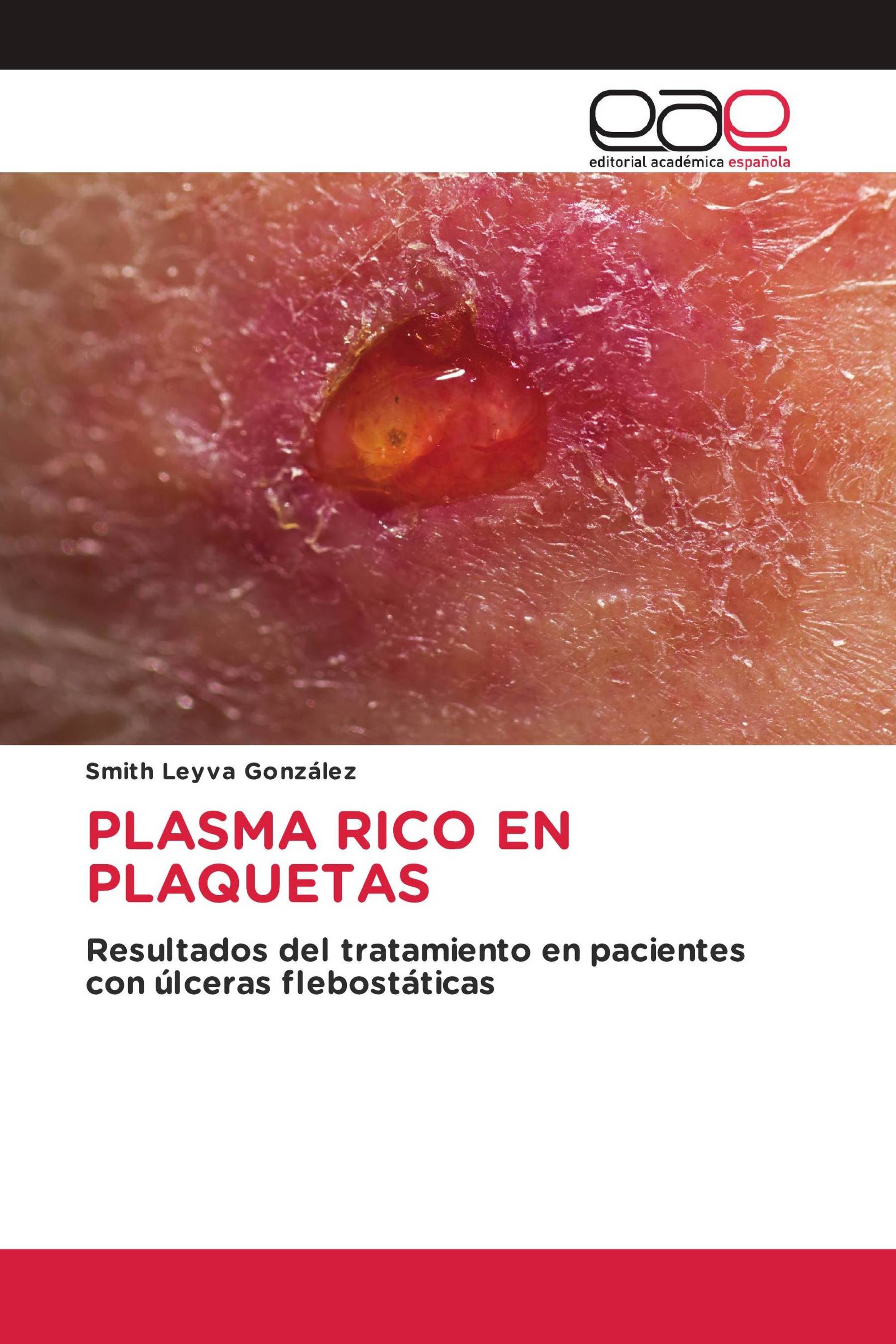 PLASMA RICO EN PLAQUETAS