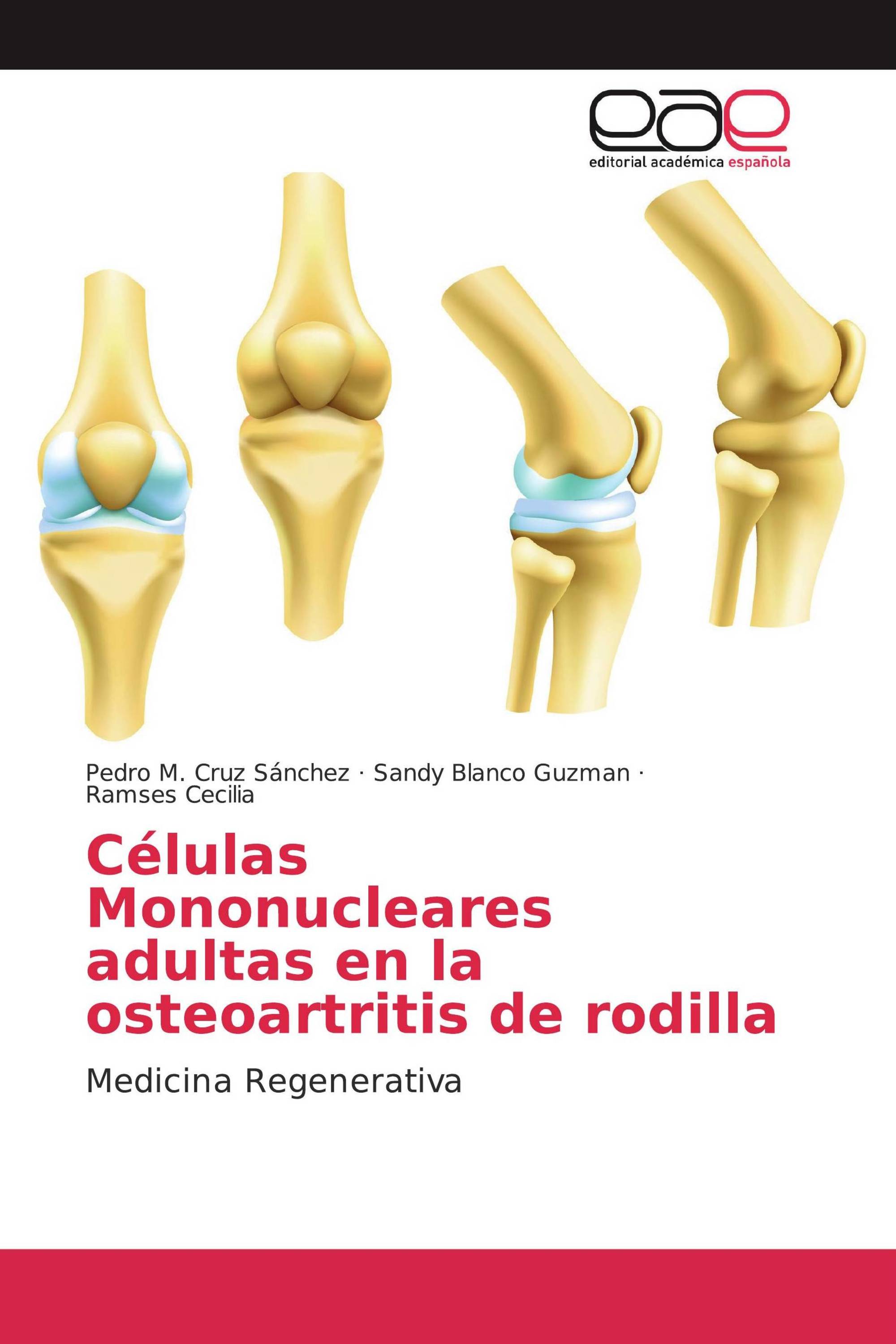 Células Mononucleares adultas en la osteoartritis de rodilla