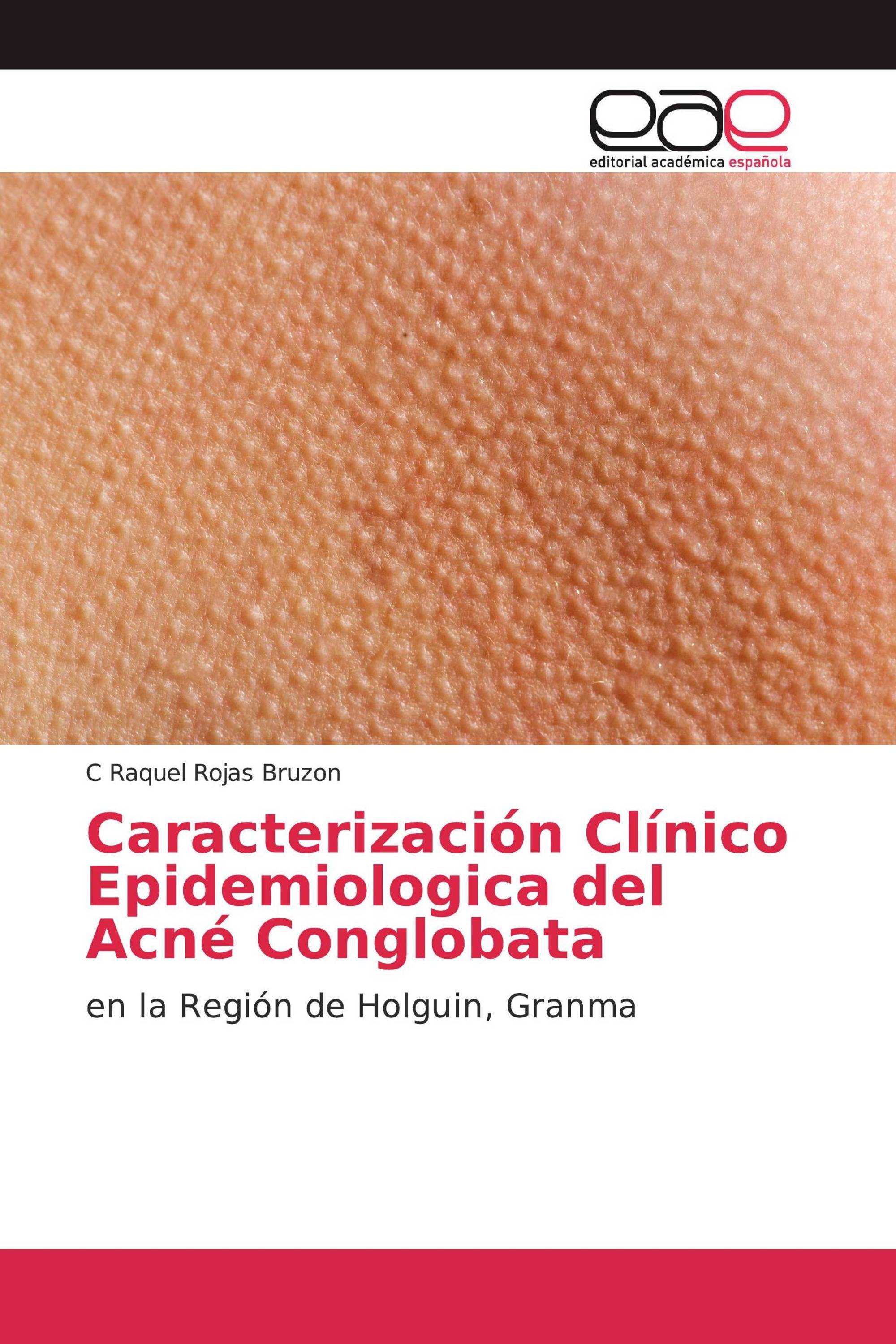 Caracterización Clínico Epidemiologica del Acné Conglobata