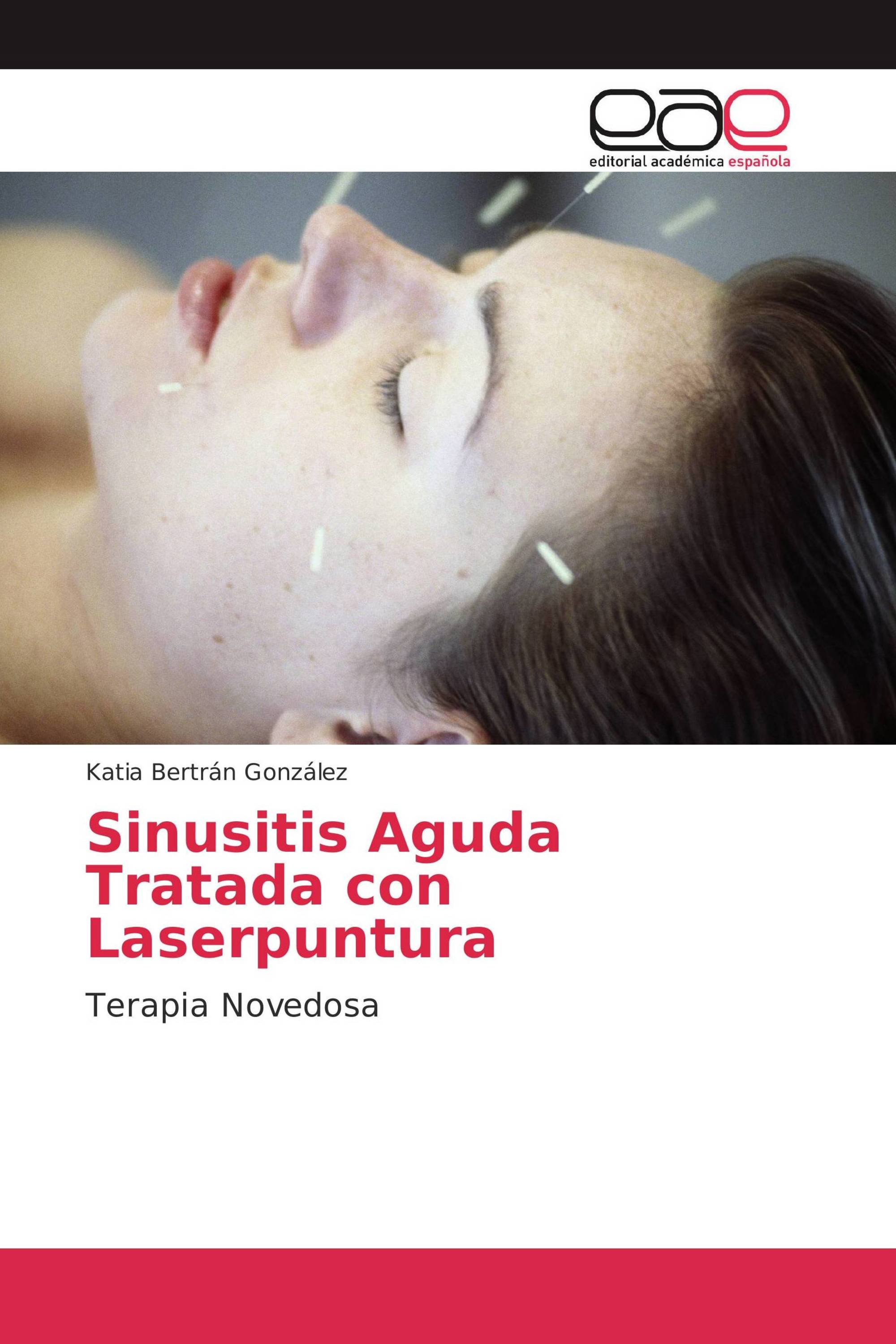 Sinusitis Aguda Tratada con Laserpuntura