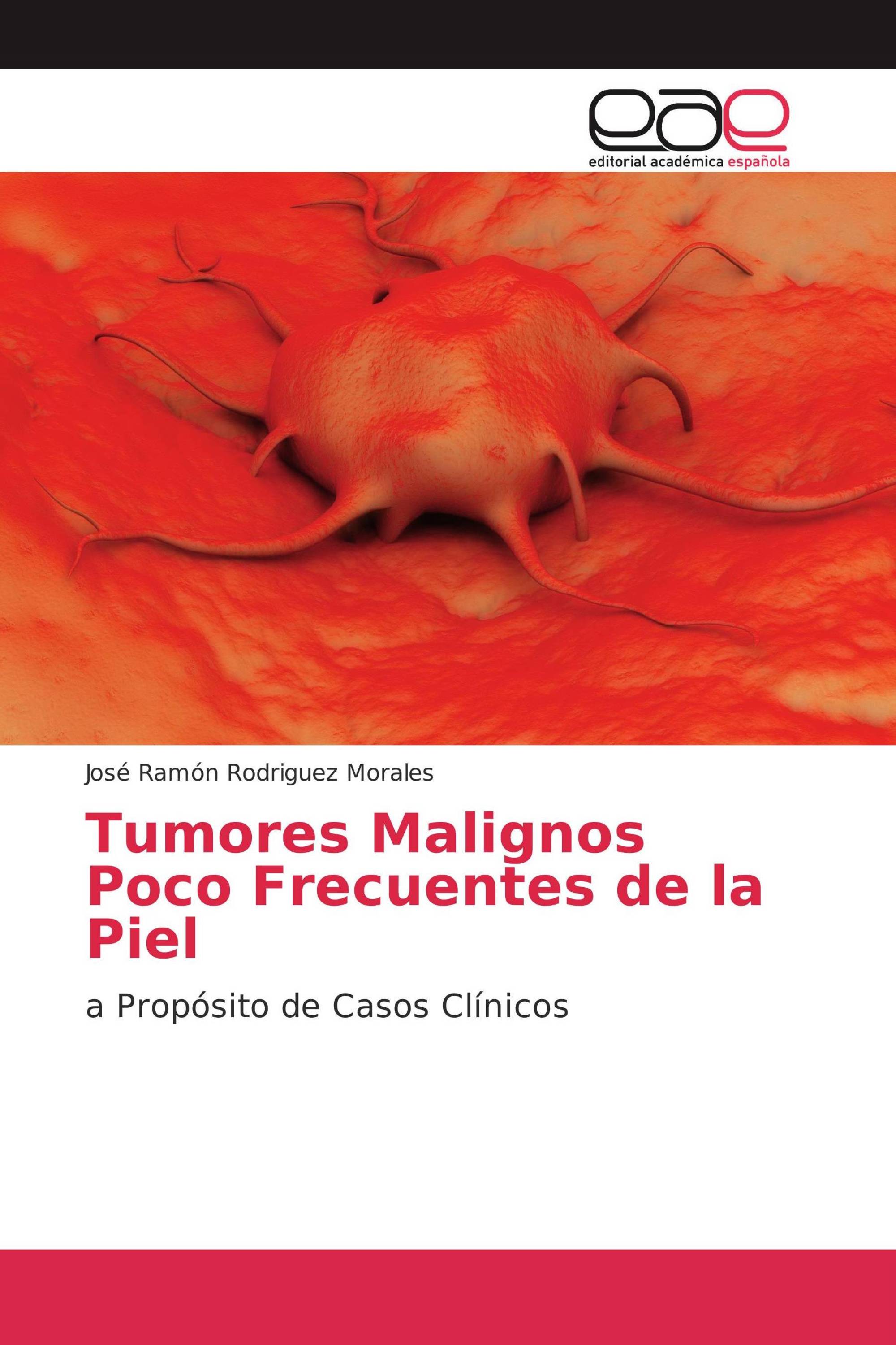 Tumores Malignos Poco Frecuentes de la Piel