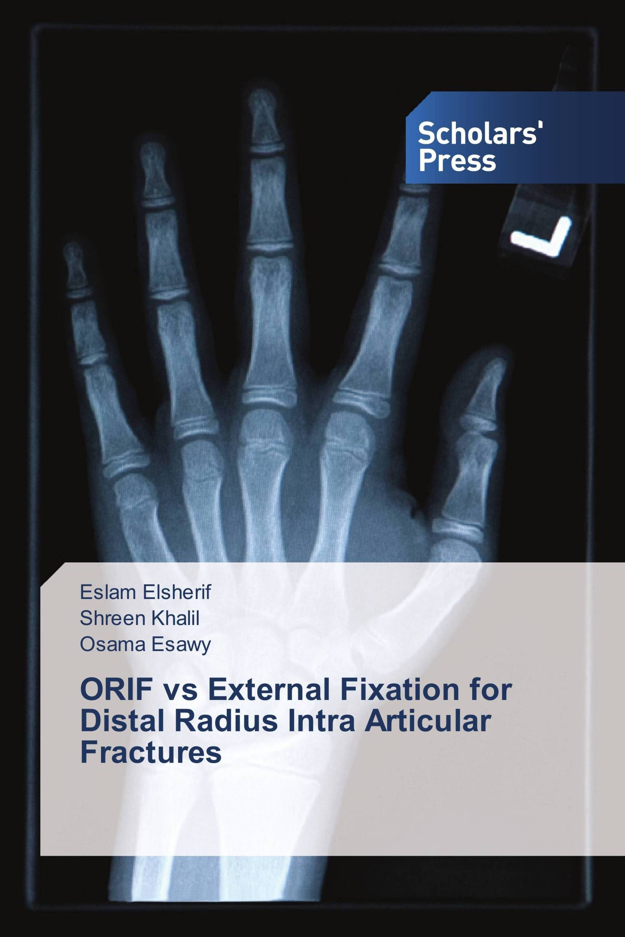 ORIF vs External Fixation for Distal Radius Intra Articular Fractures