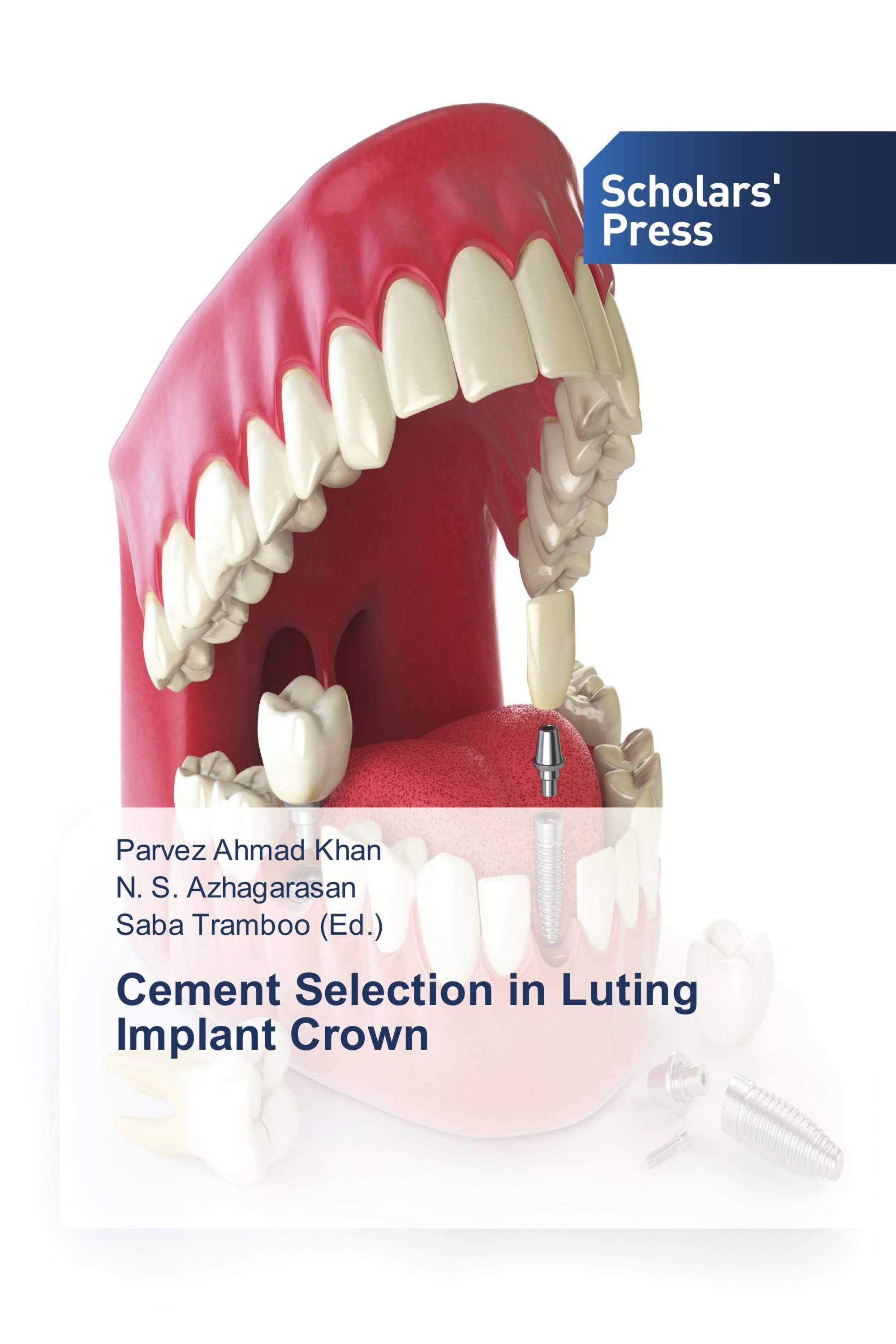 Cement Selection in Luting Implant Crown