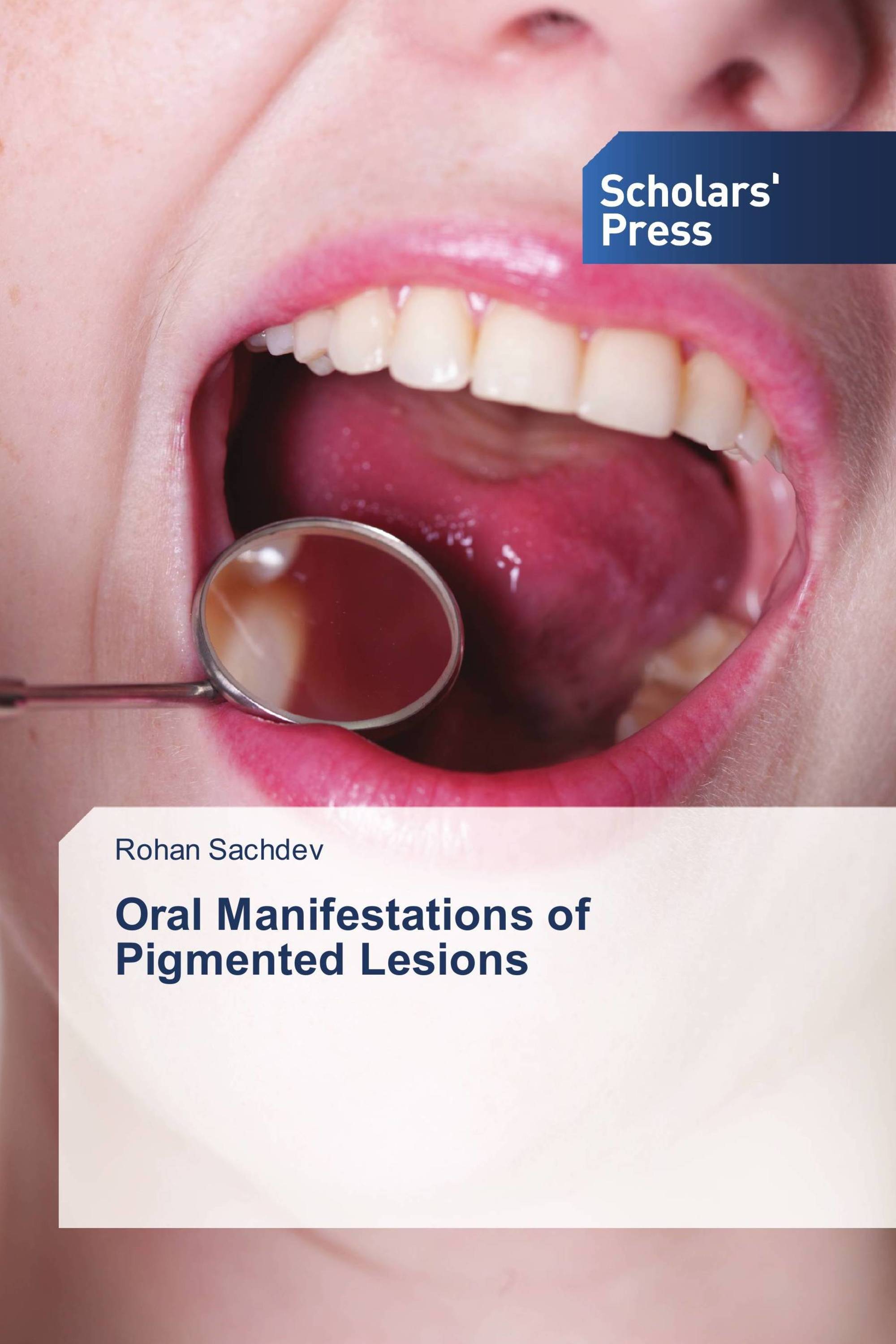 Oral Manifestations of Pigmented Lesions