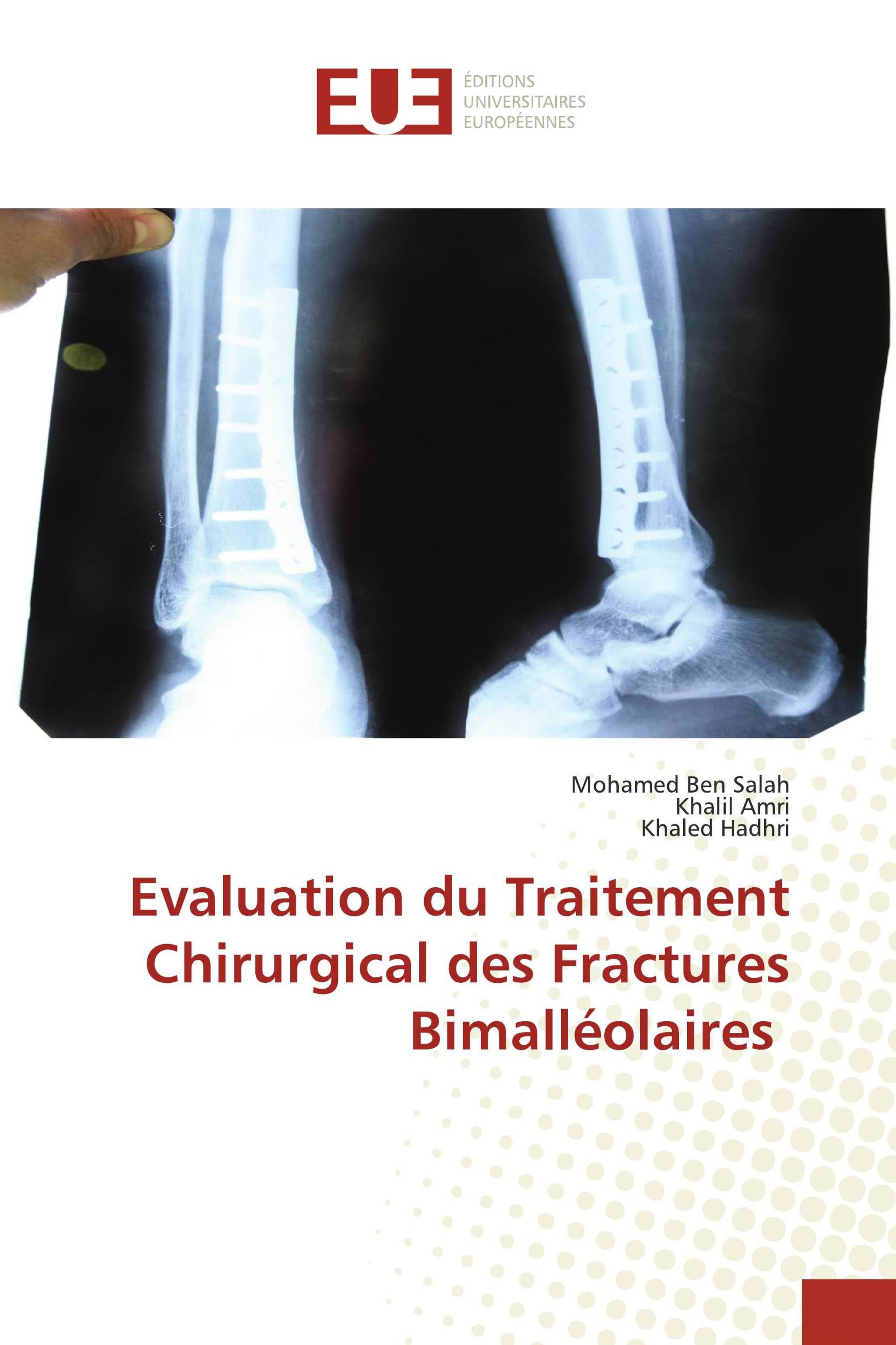 Evaluation du Traitement Chirurgical des Fractures Bimalléolaires