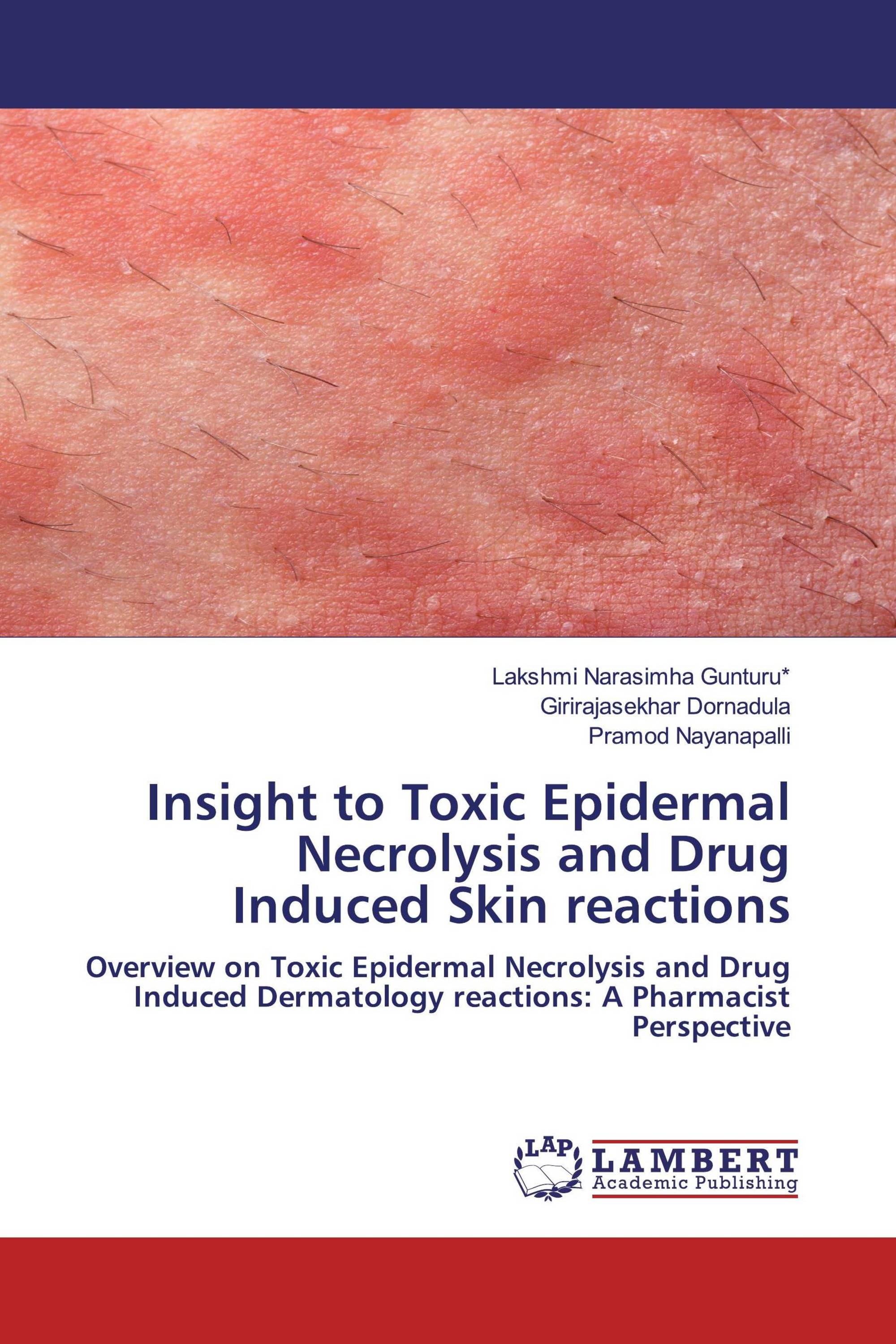 Insight to Toxic Epidermal Necrolysis and Drug Induced Skin reactions