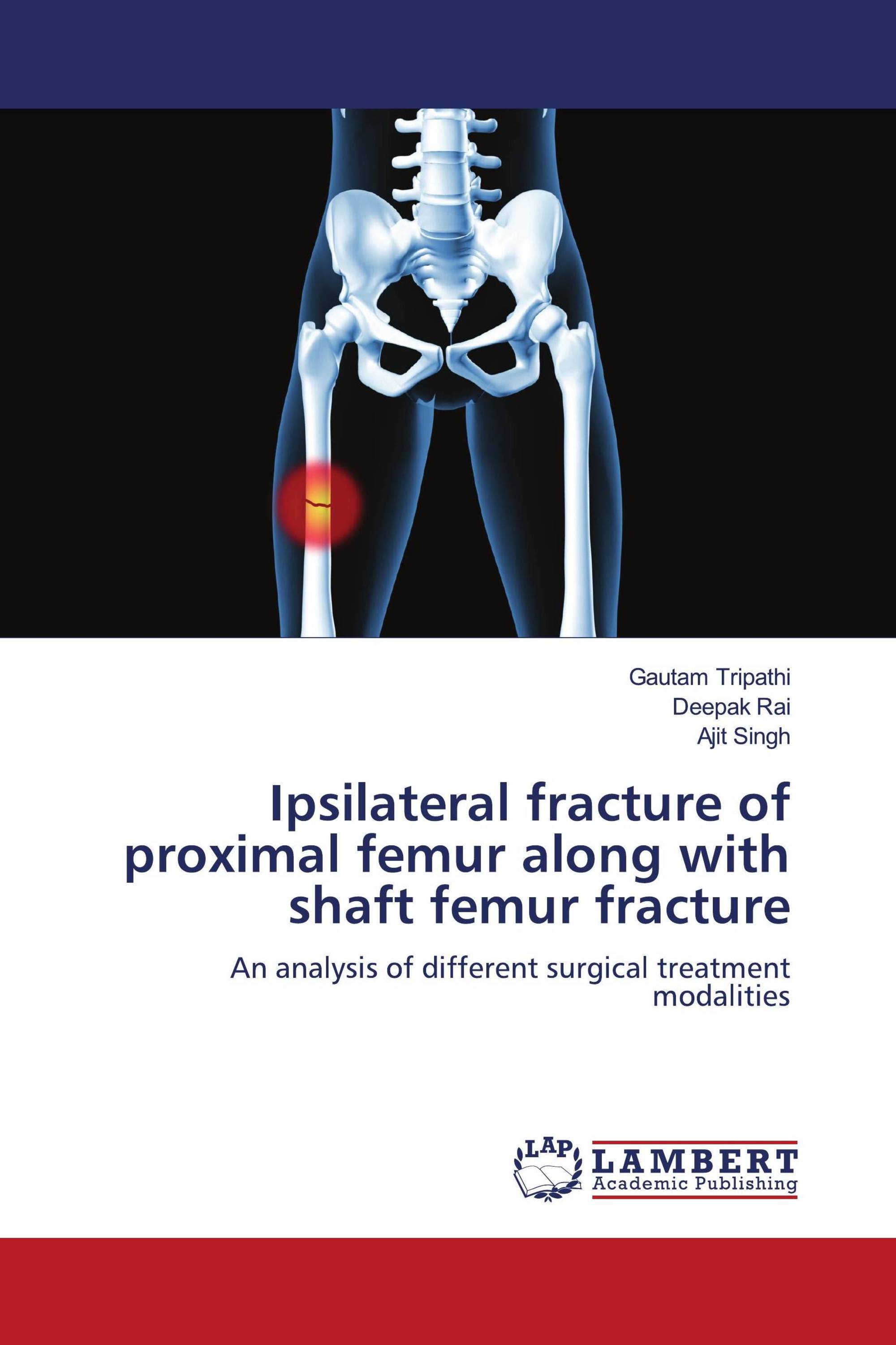 Ipsilateral fracture of proximal femur along with shaft femur fracture