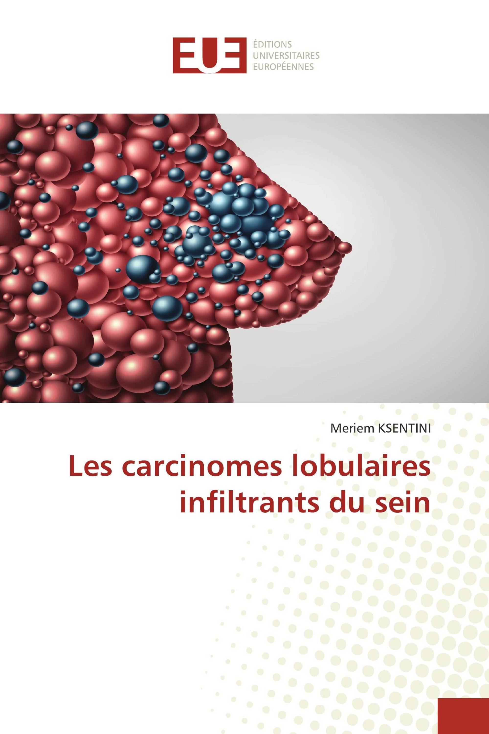 Les carcinomes lobulaires infiltrants du sein