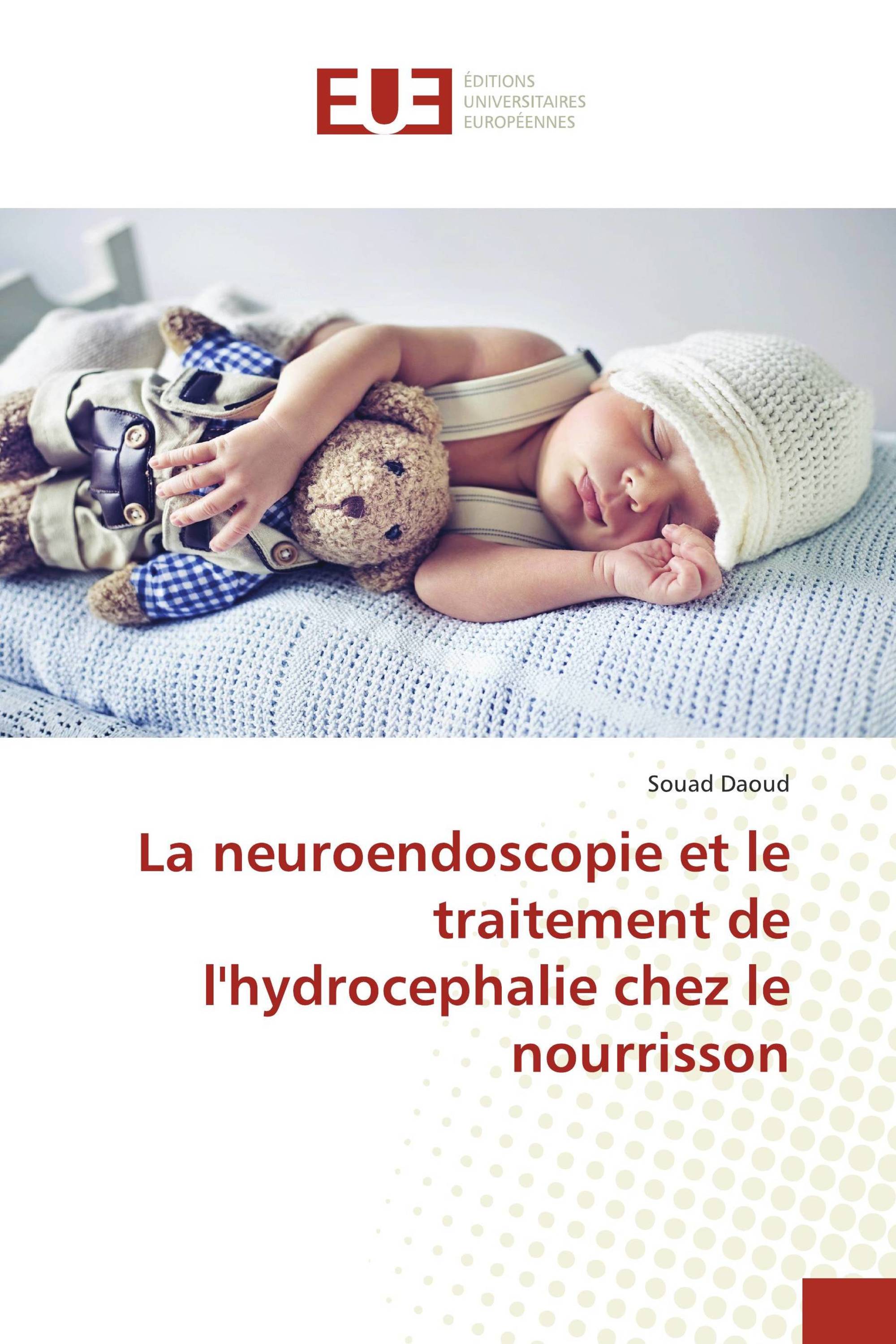 La Neuroendoscopie Et Le Traitement De Lhydrocephalie Chez Le Nourrisson 978 620 3 43700 3 4379