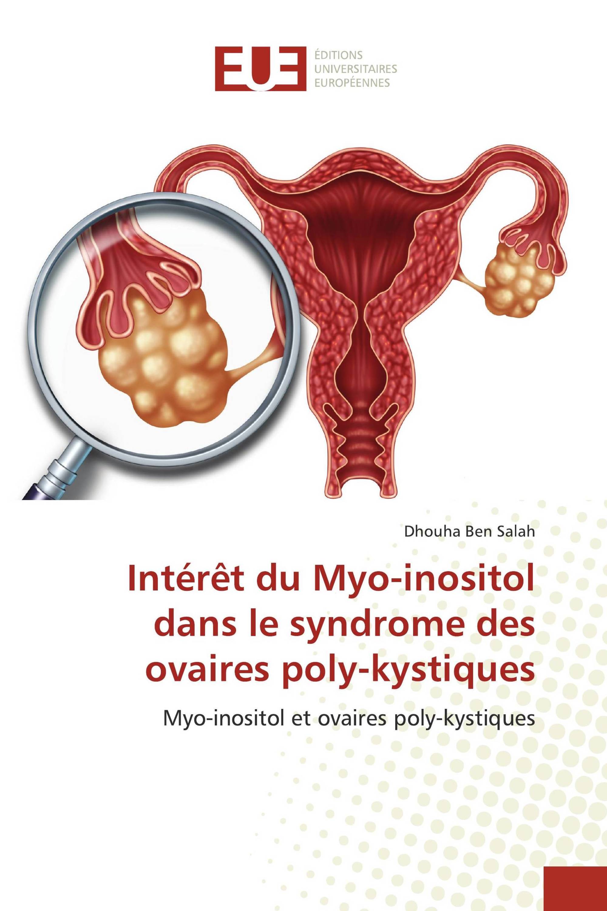 Intérêt du Myo-inositol dans le syndrome des ovaires poly-kystiques