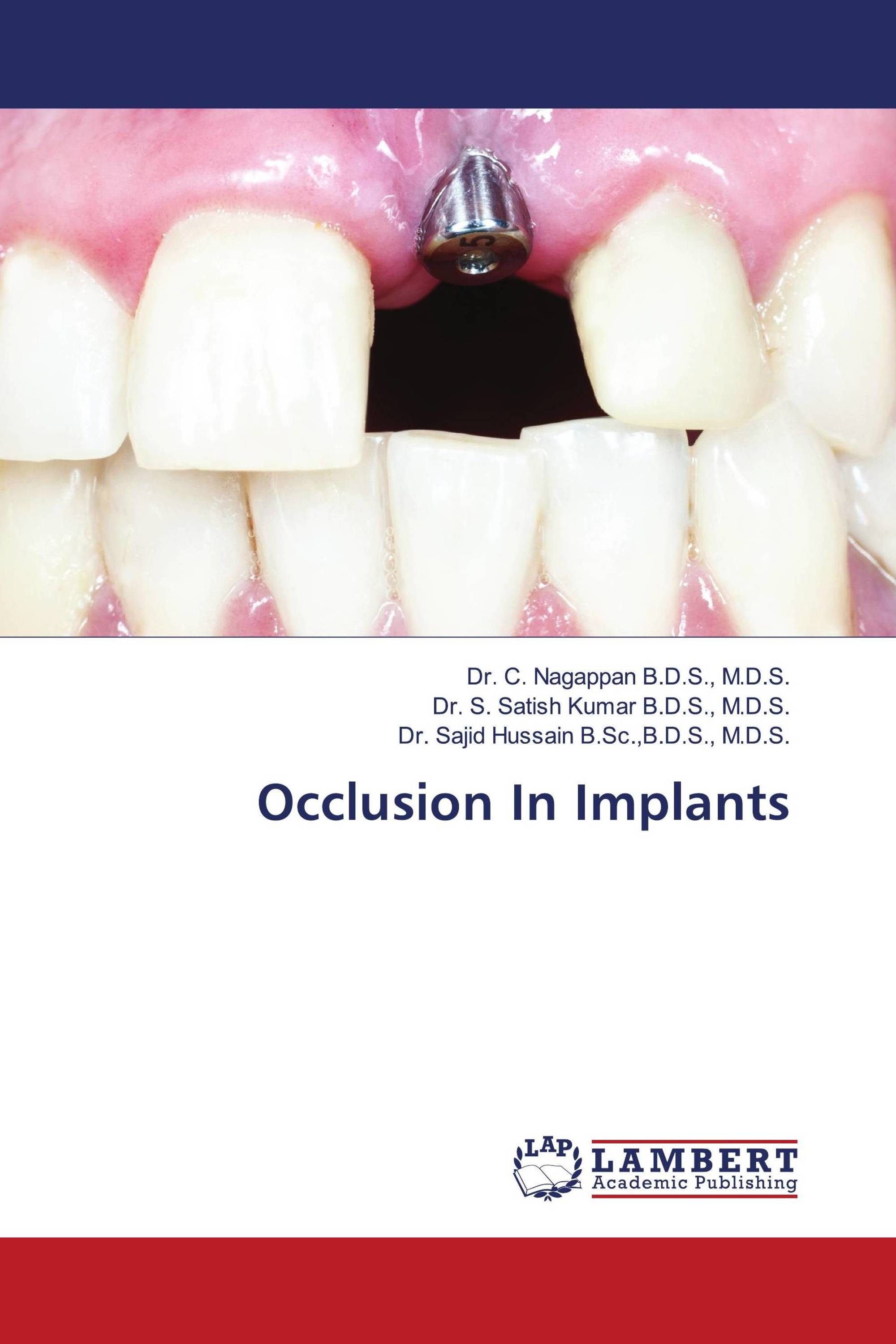 Occlusion In Implants / 978-620-3-92937-9 / 9786203929379 / 6203929379