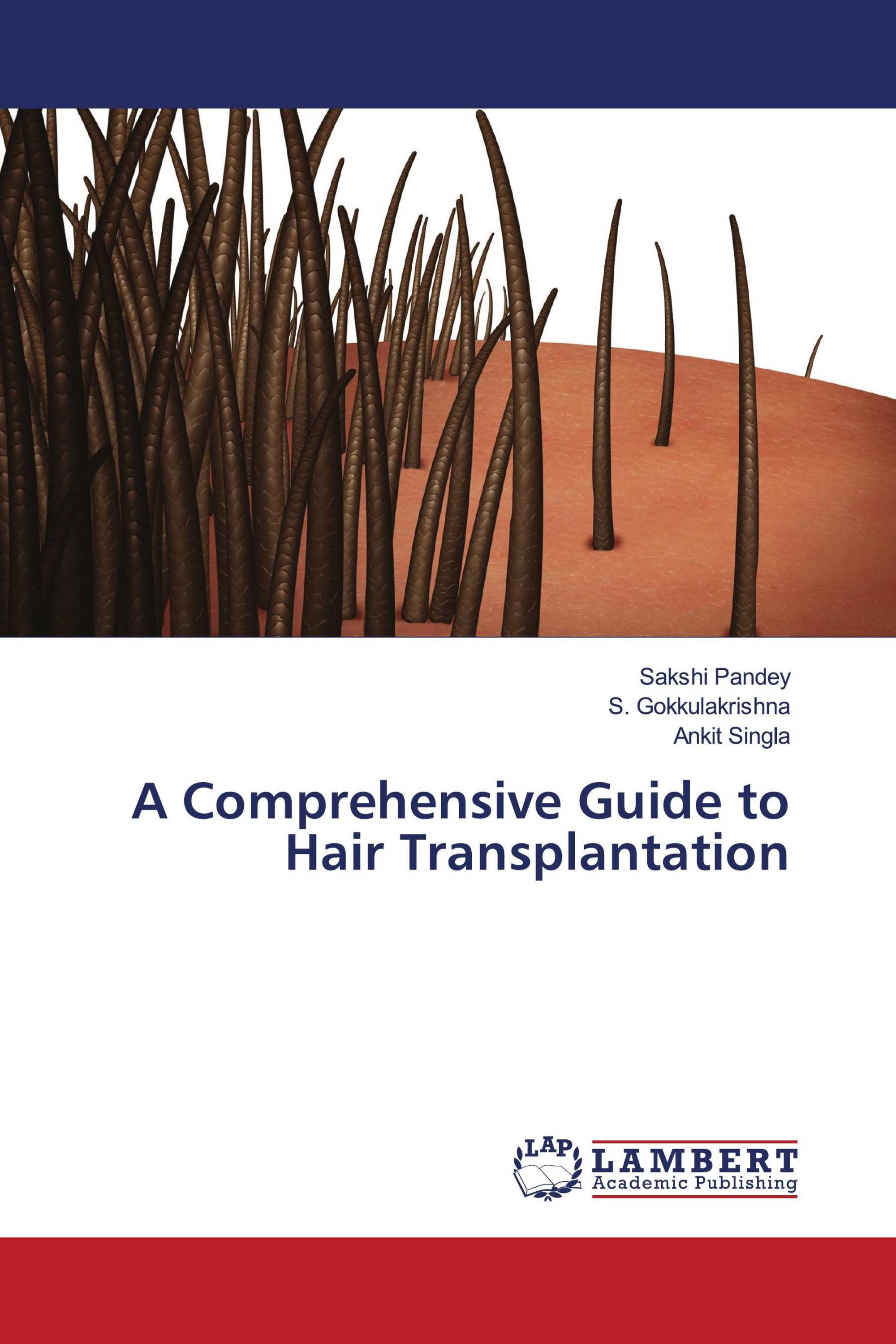 A Comprehensive Guide to Hair Transplantation / 978-620-4-72956-5 