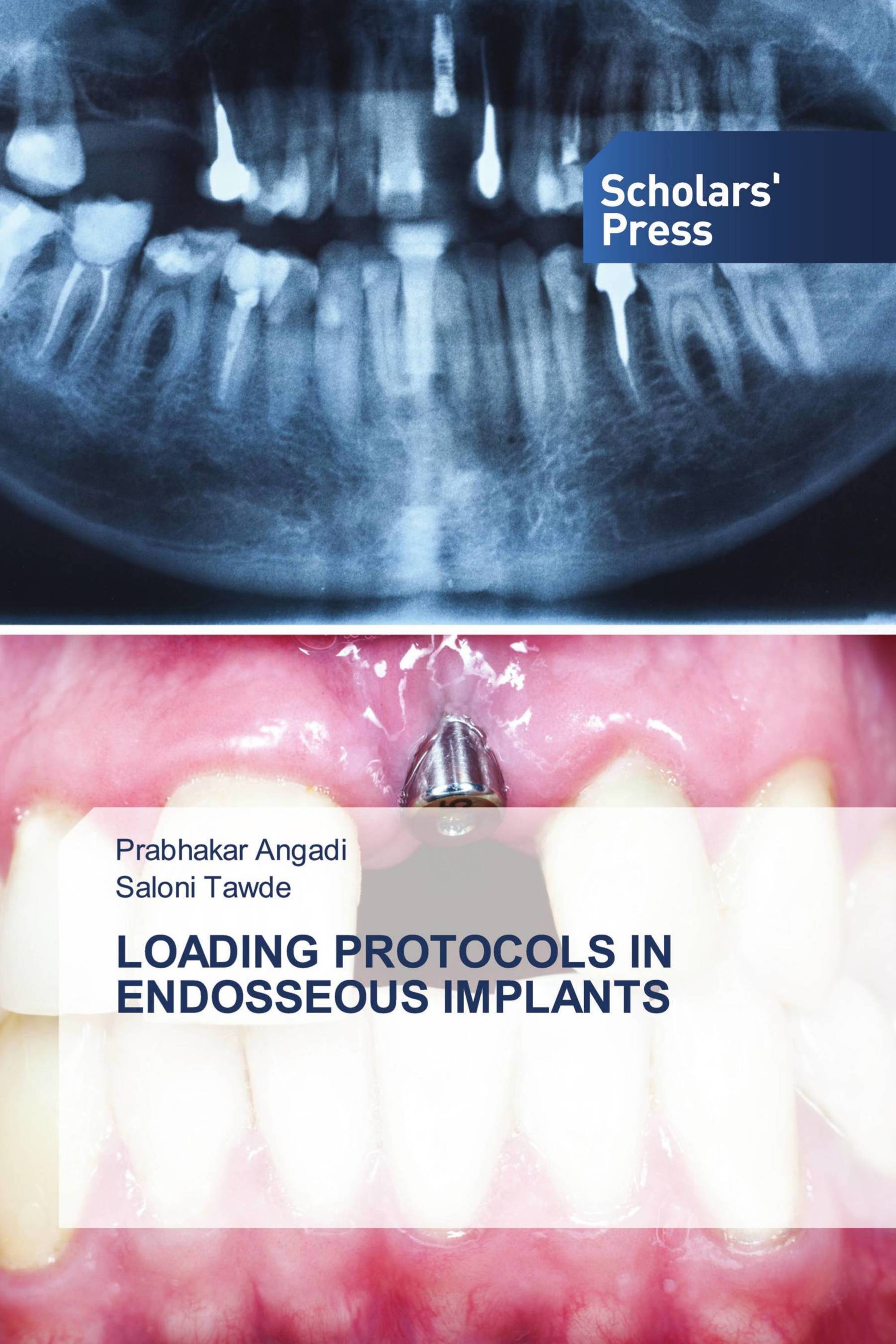 LOADING PROTOCOLS IN ENDOSSEOUS IMPLANTS