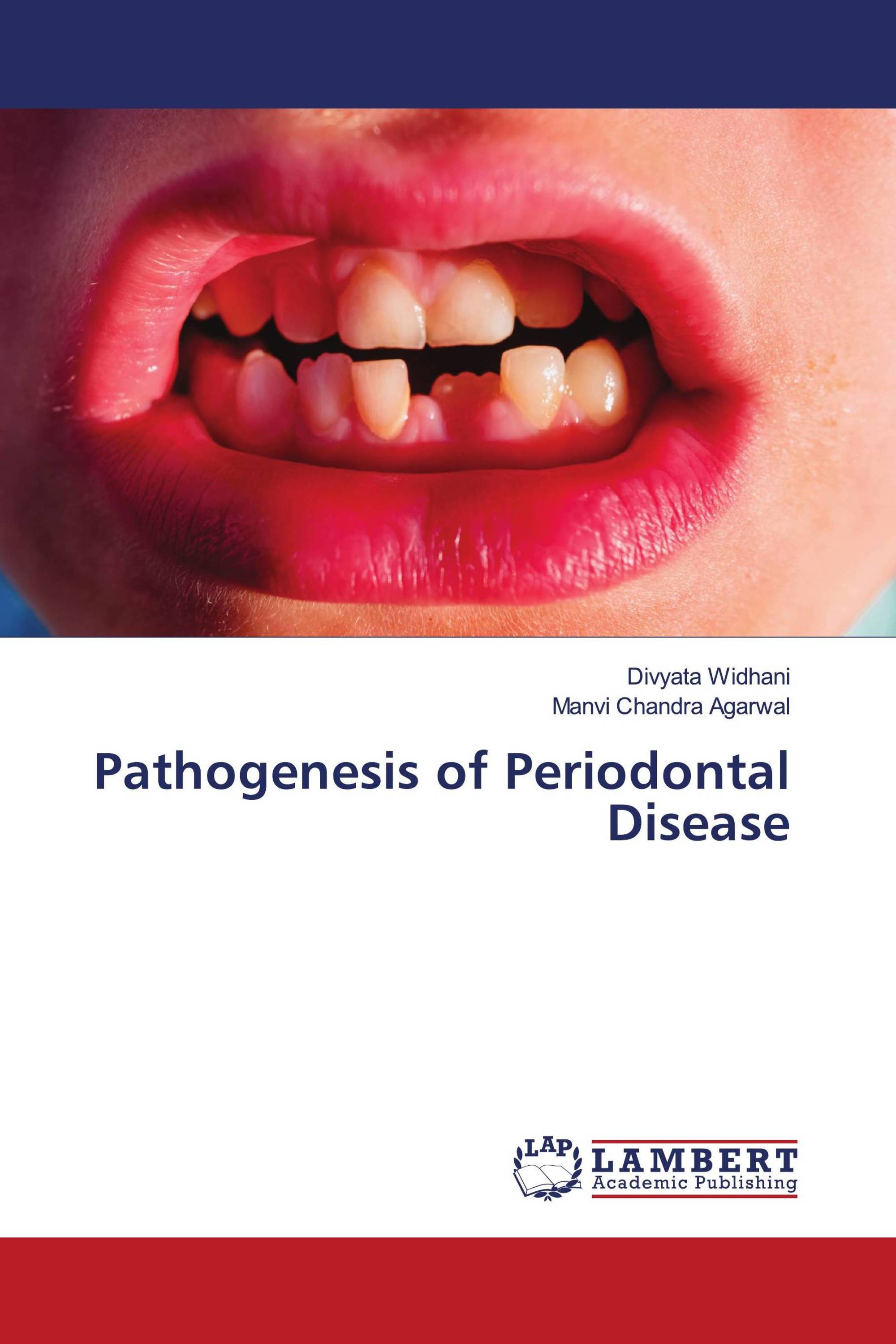 Pathogenesis Of Periodontal Disease 978 620 6 14467 0 9786206144670