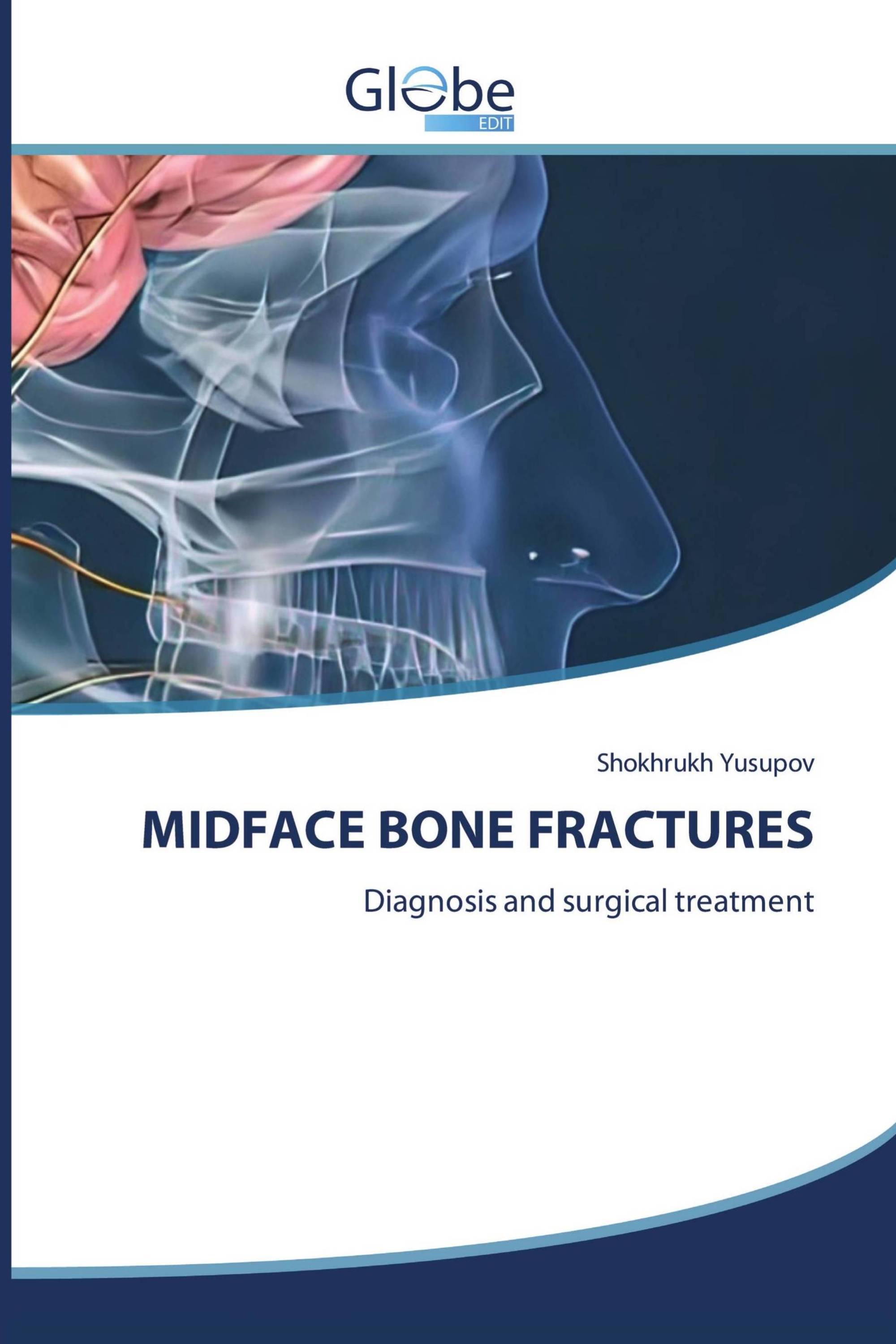 MIDFACE BONE FRACTURES