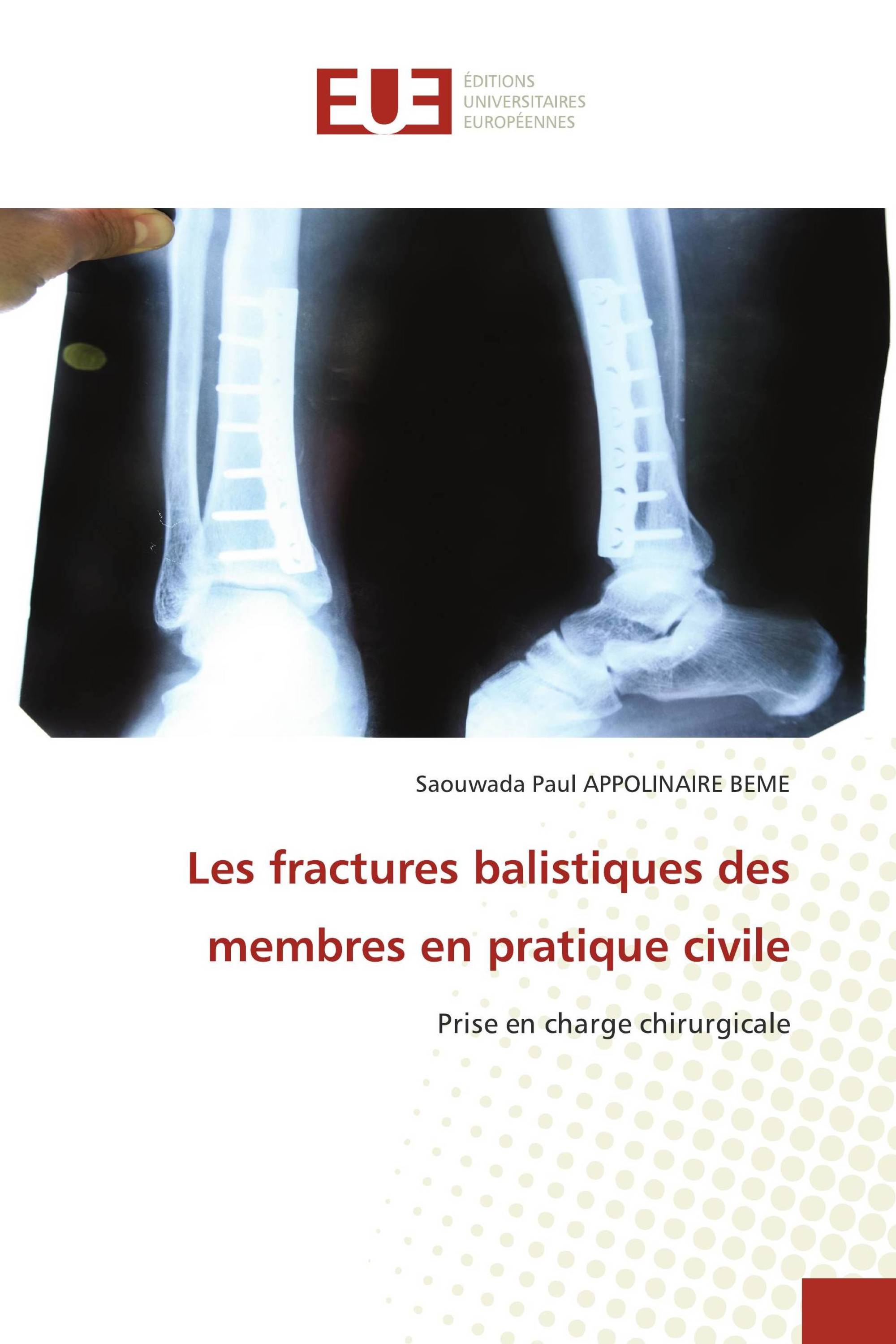 Les fractures balistiques des membres en pratique civile