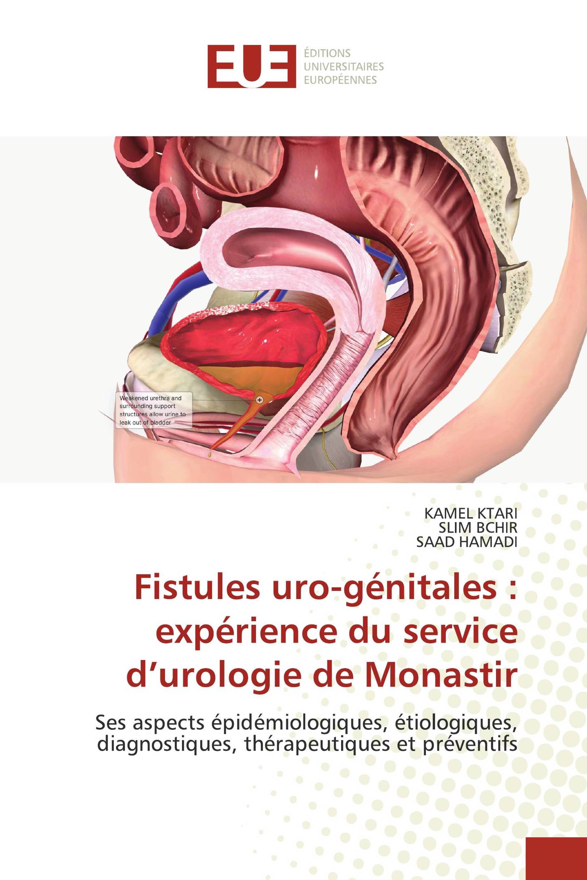 Fistules uro-génitales : expérience du service d’urologie de Monastir