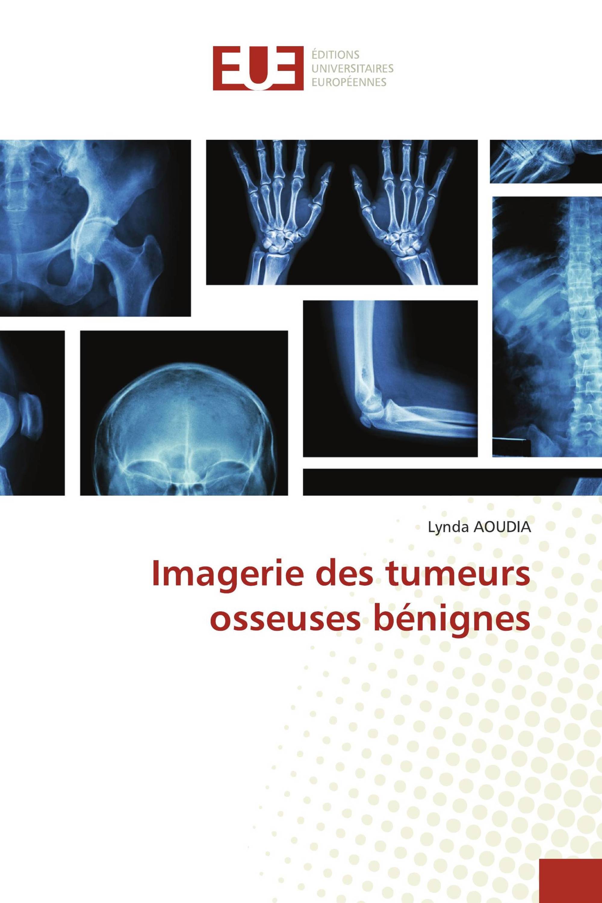 Imagerie des tumeurs osseuses bénignes