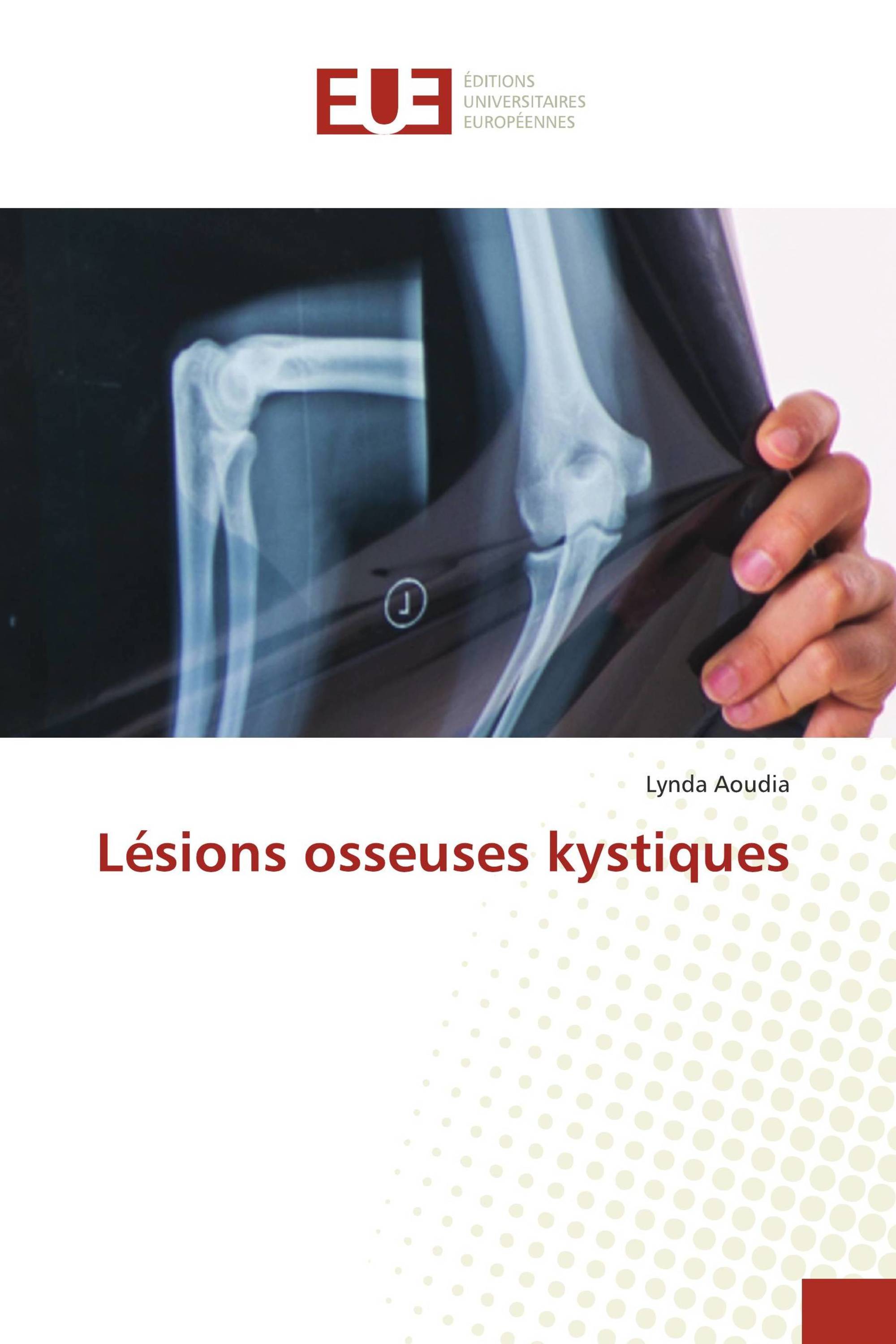 Lésions osseuses kystiques