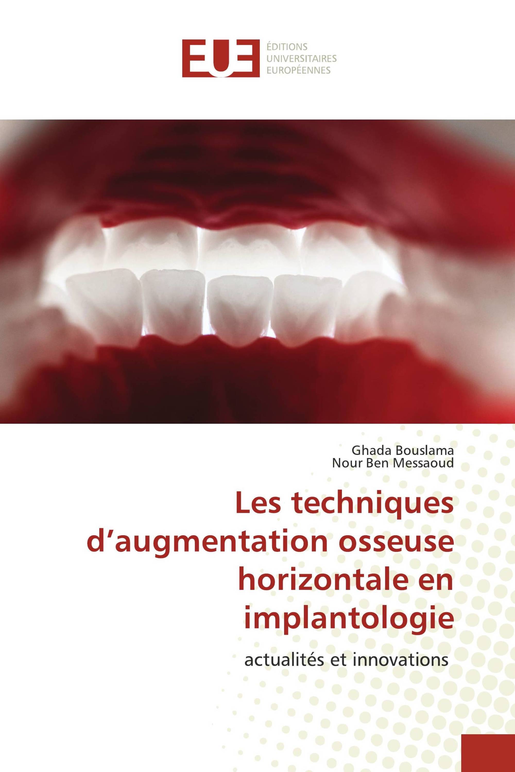 Les techniques d’augmentation osseuse horizontale en implantologie