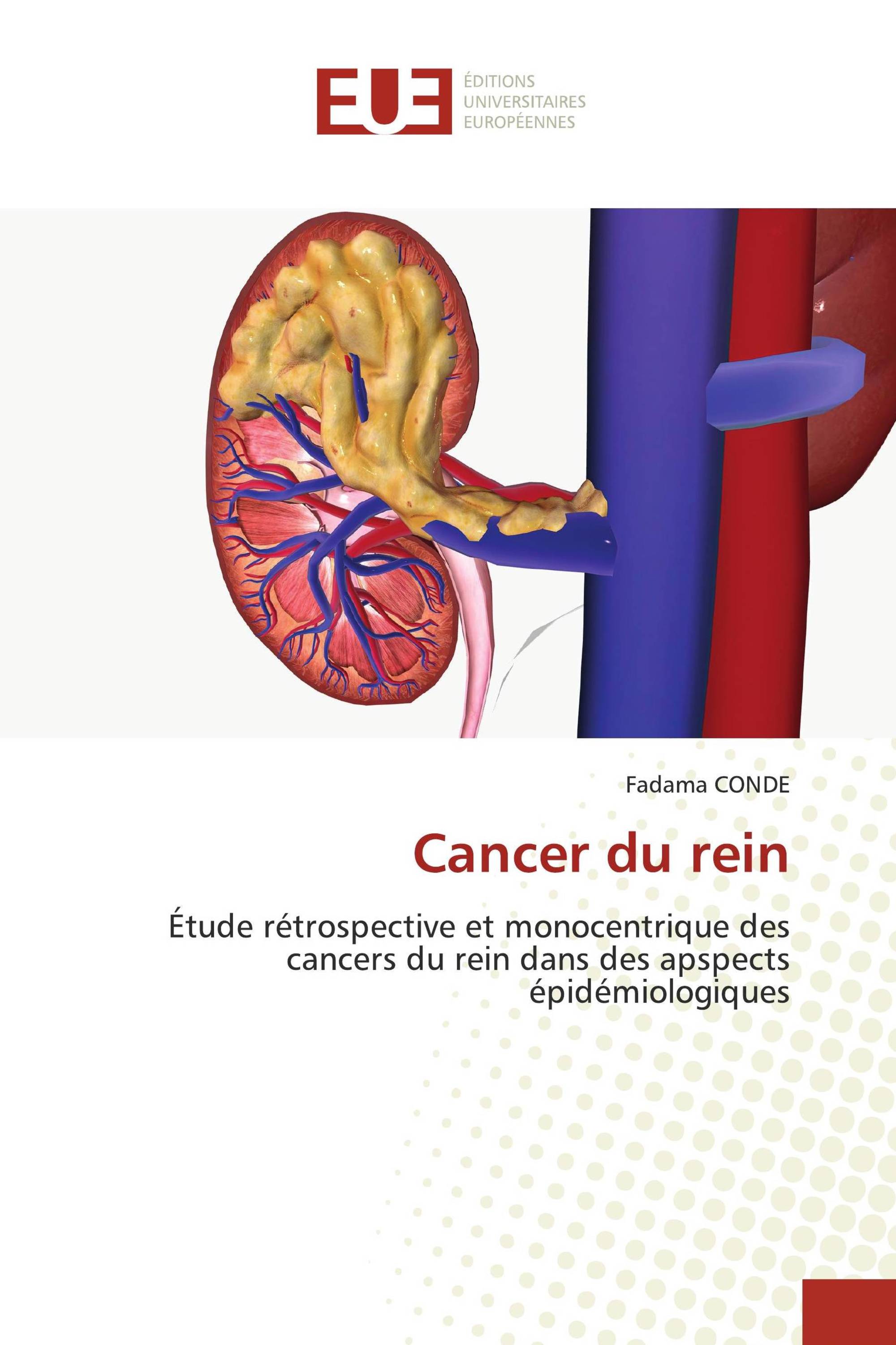 Cancer du rein