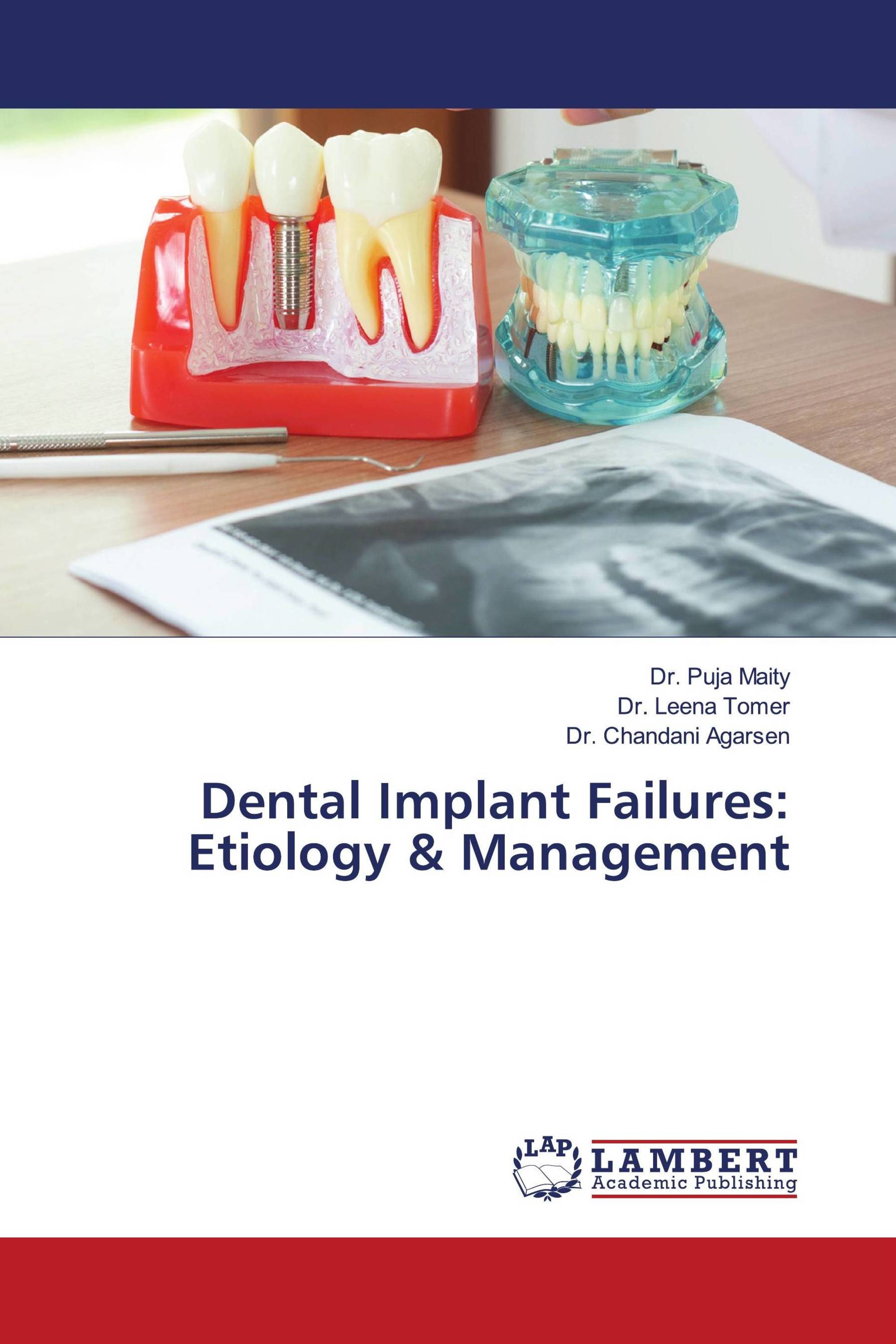 The Etiology And Management Of Dental Implant Failure: A Review – AULDOU