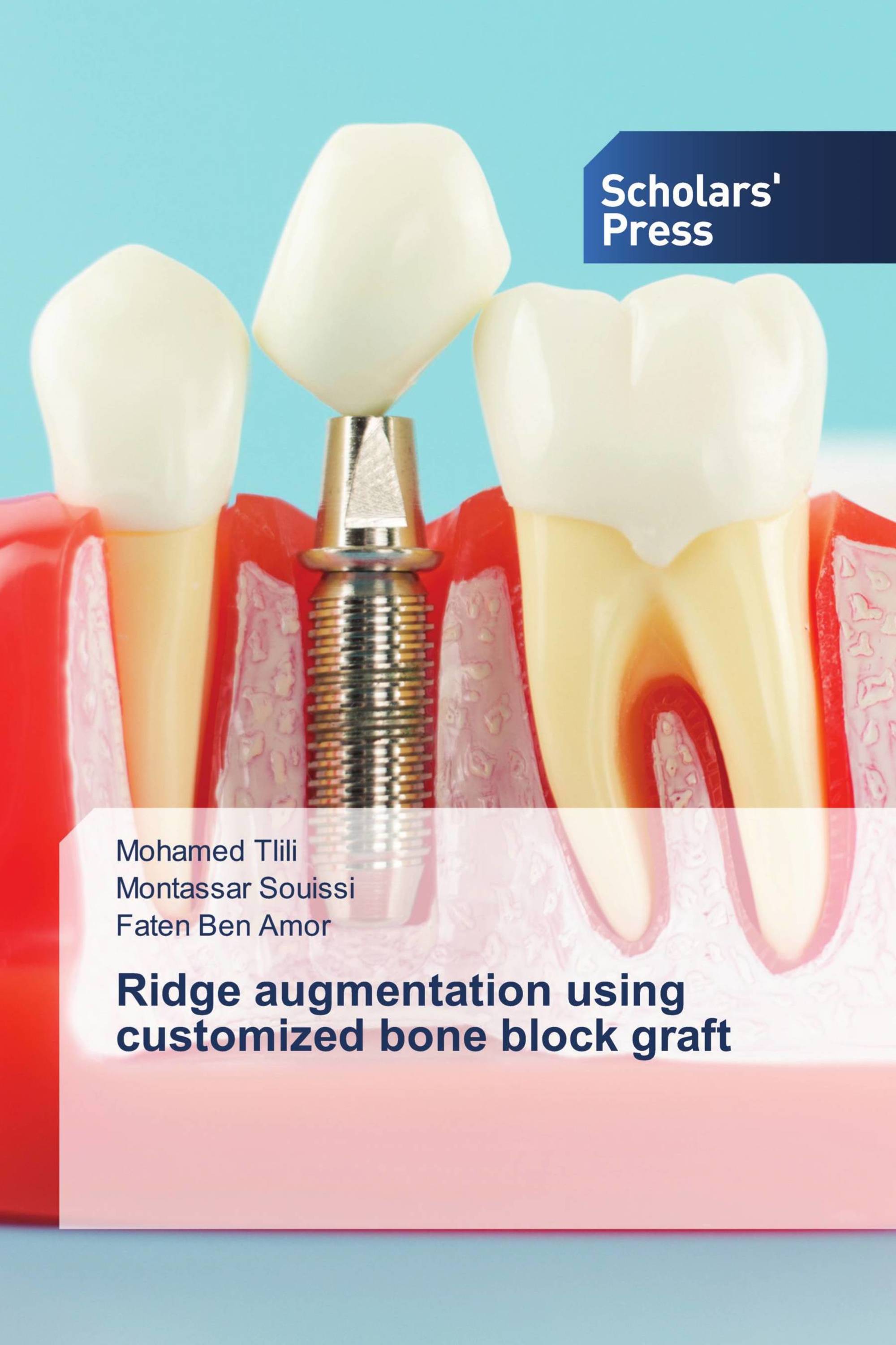 Ridge augmentation using customized bone block graft