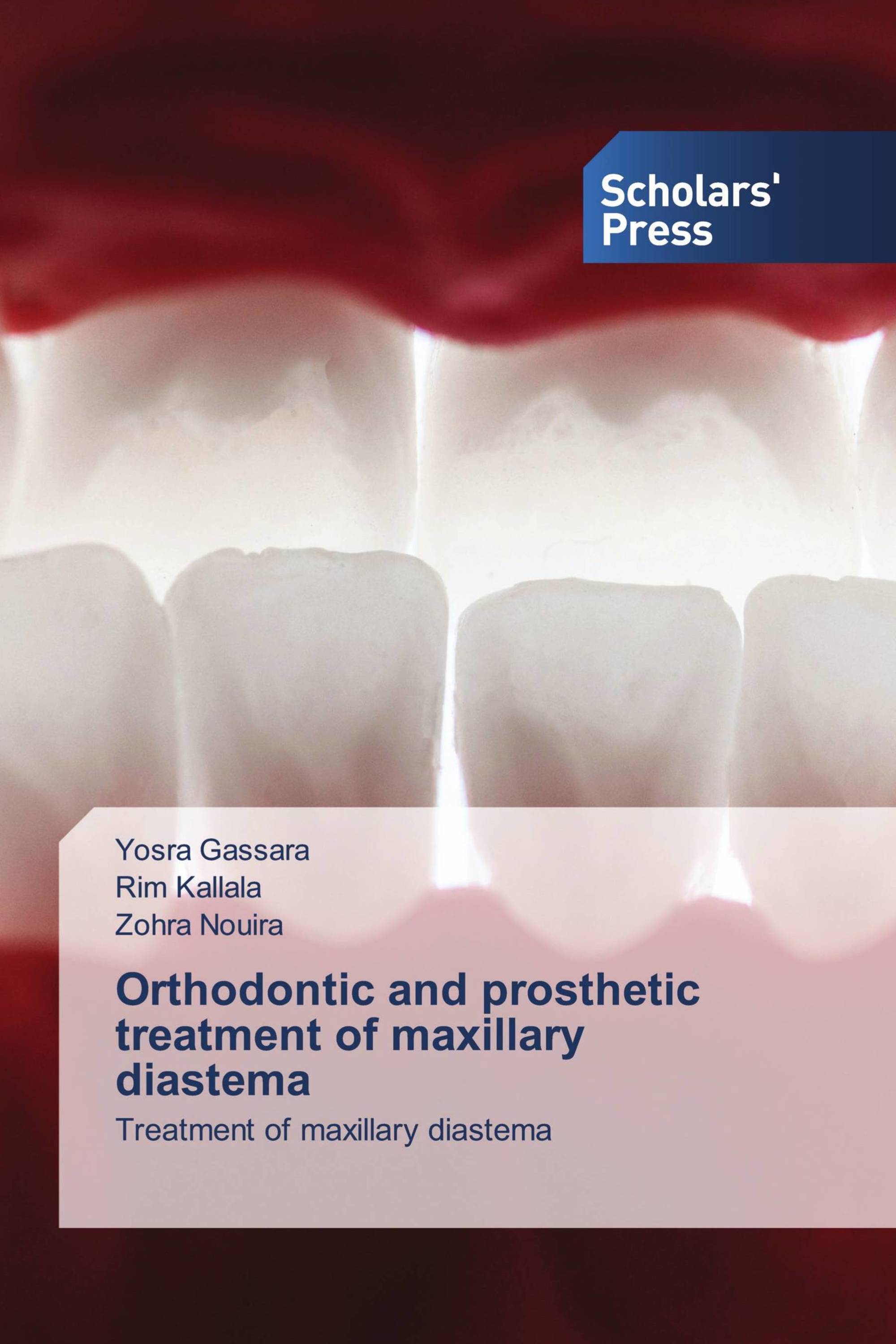 Orthodontic and prosthetic treatment of maxillary diastema