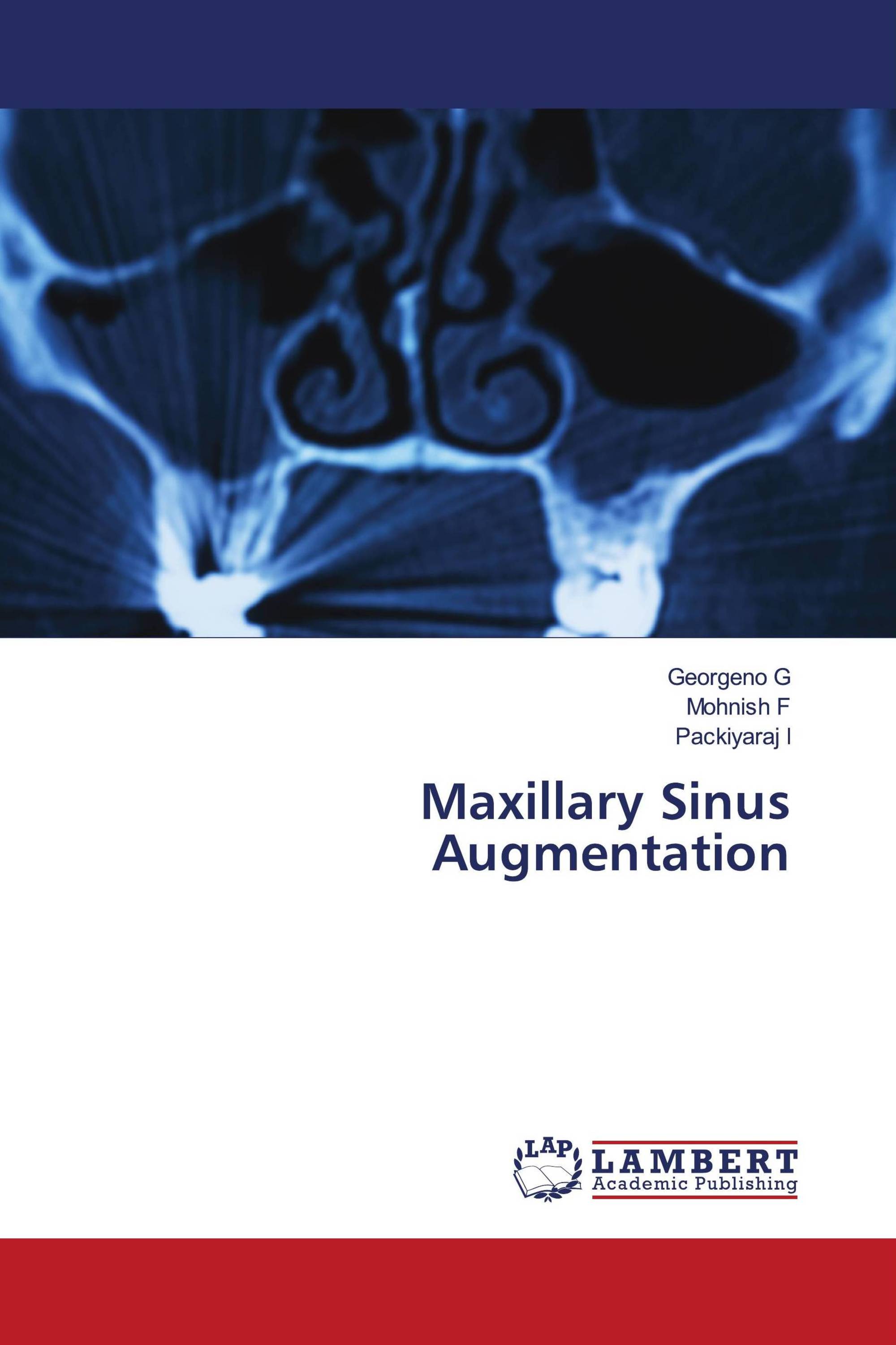 Maxillary Sinus Augmentation 978 620 6 79102 7 9786206791027 6206791025 9183