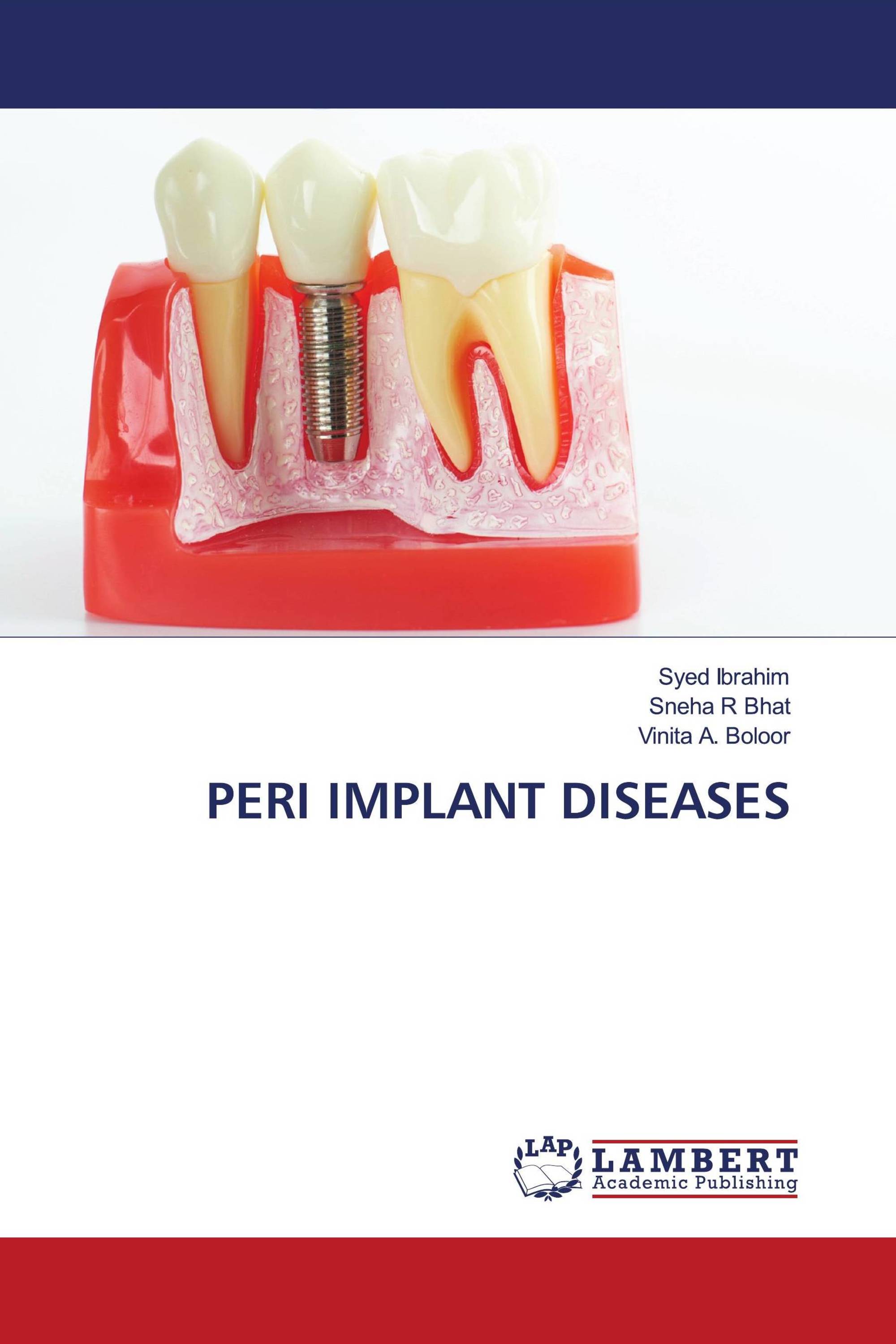 PERI IMPLANT DISEASES / 978-620-7-47104-1 / 9786207471041 / 6207471040