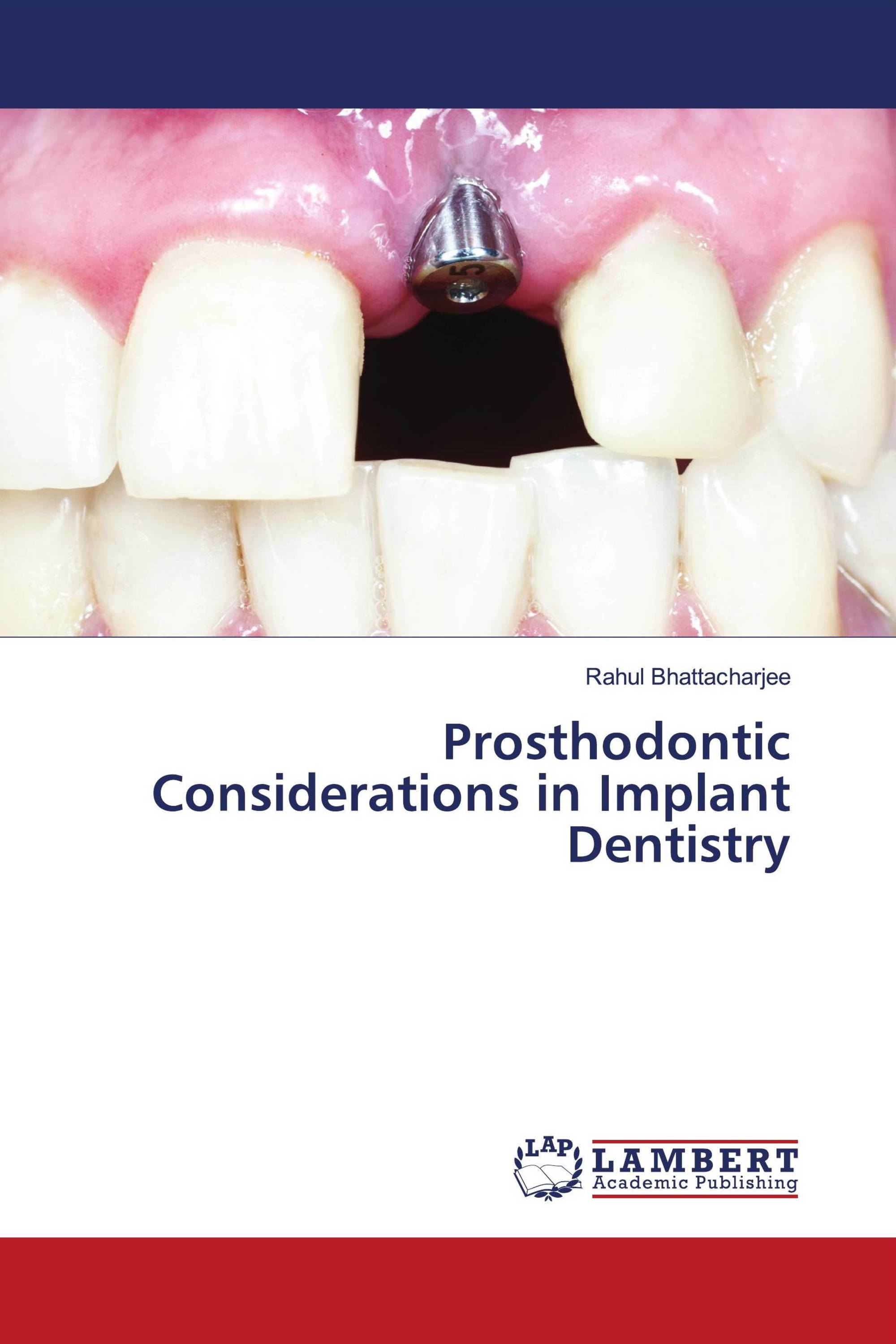 Prosthodontic Considerations in Implant Dentistry