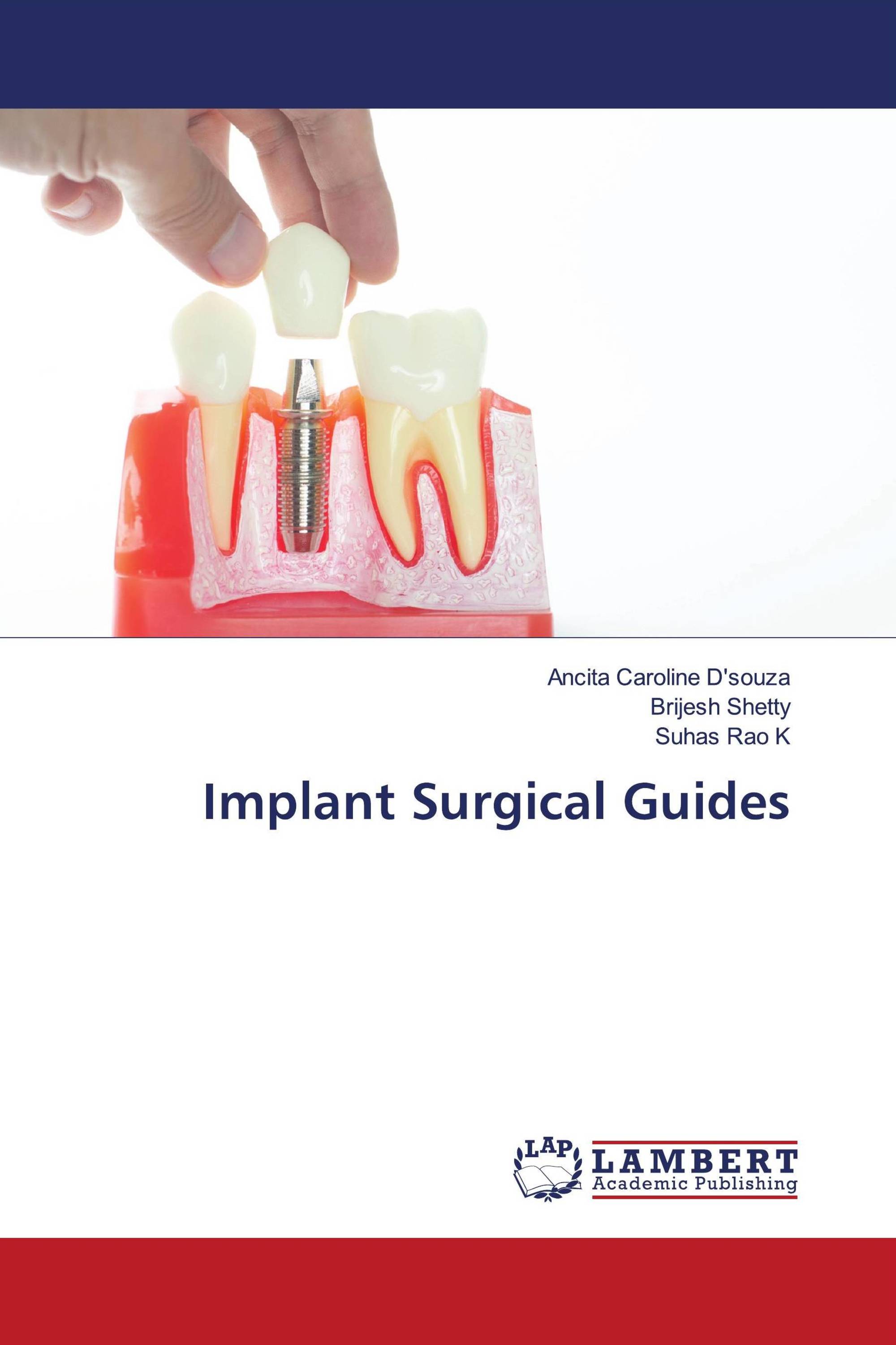 Implant Surgical Guides