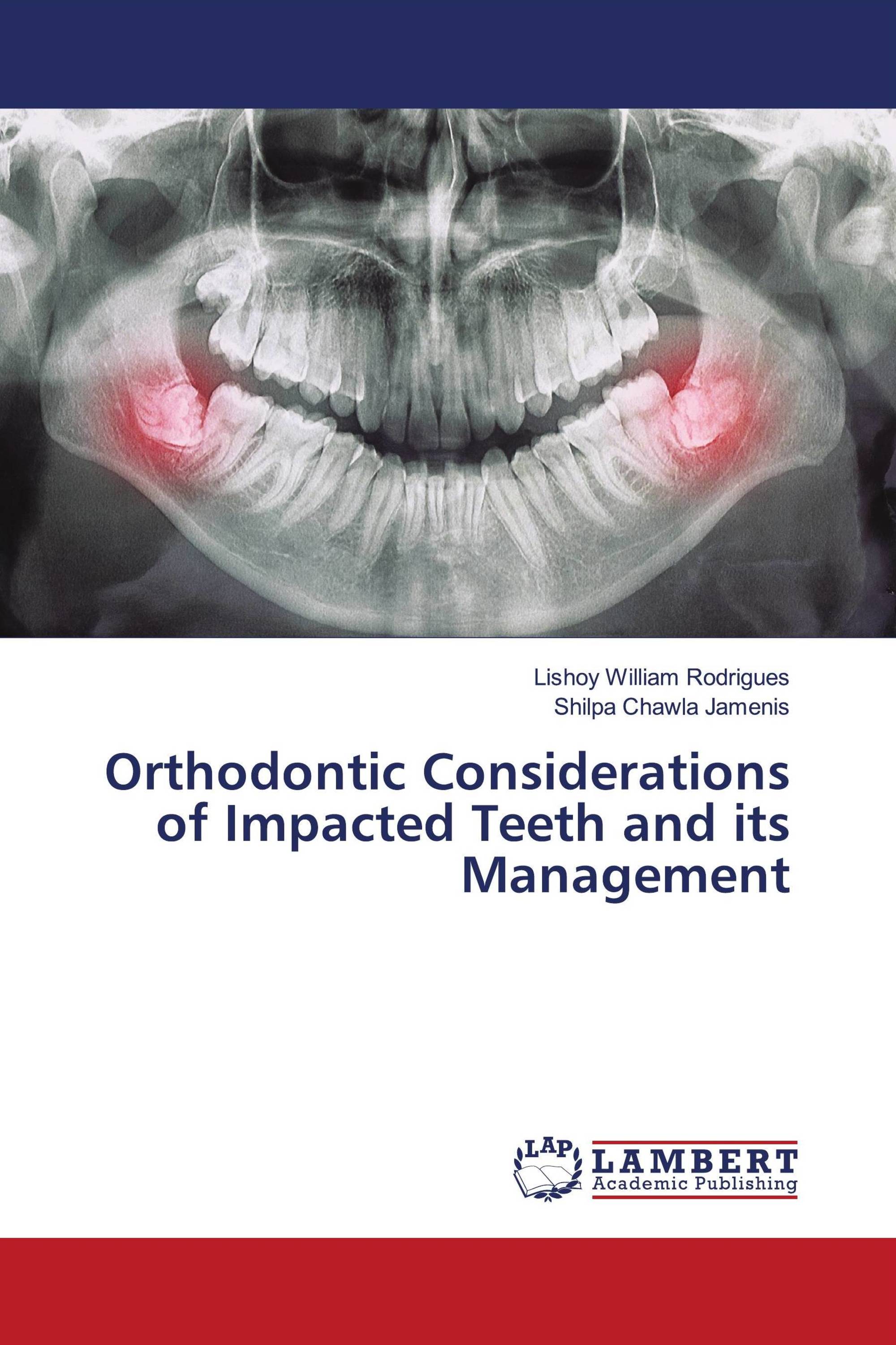 Orthodontic Considerations of Impacted Teeth and its Management