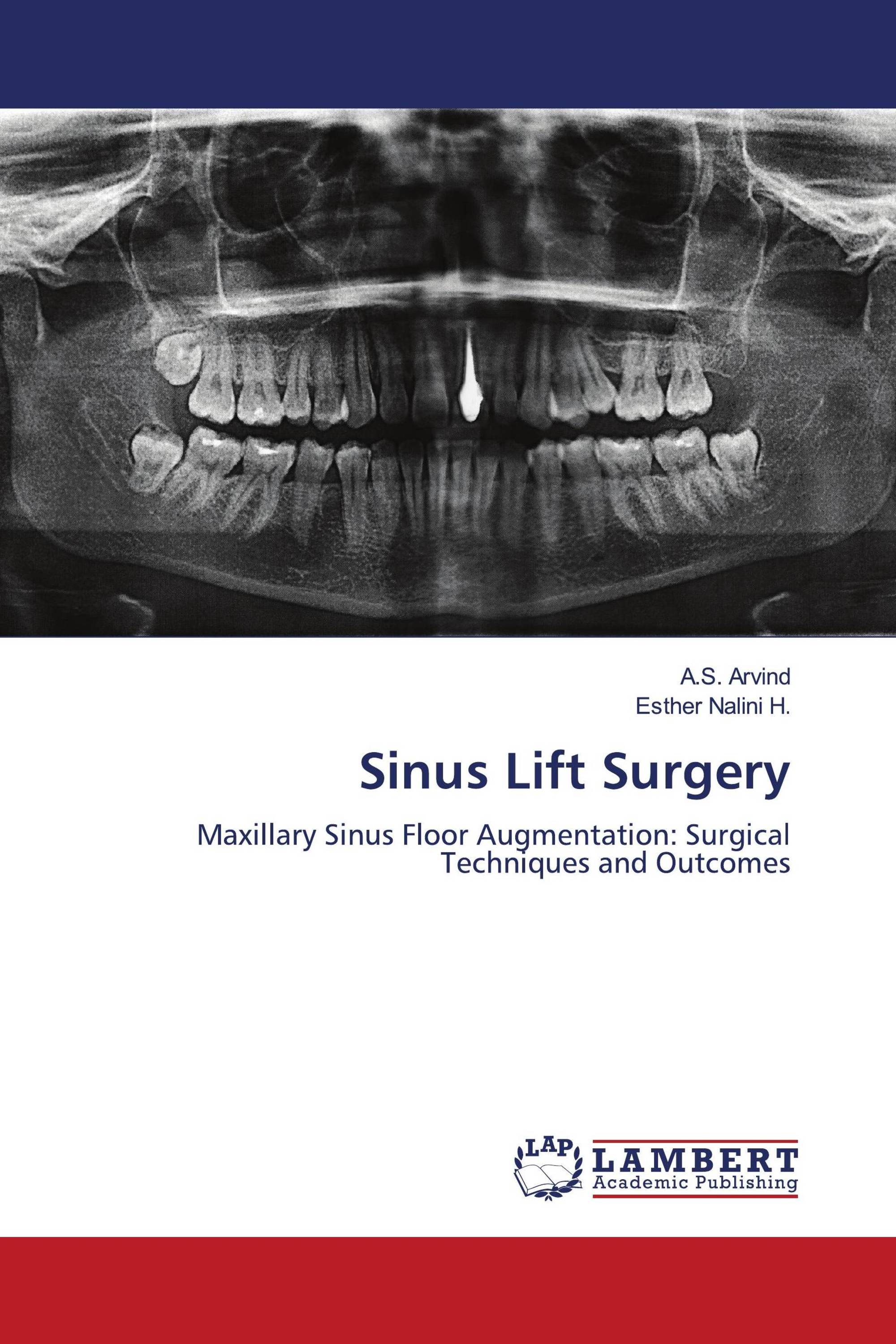 Sinus Lift Surgery