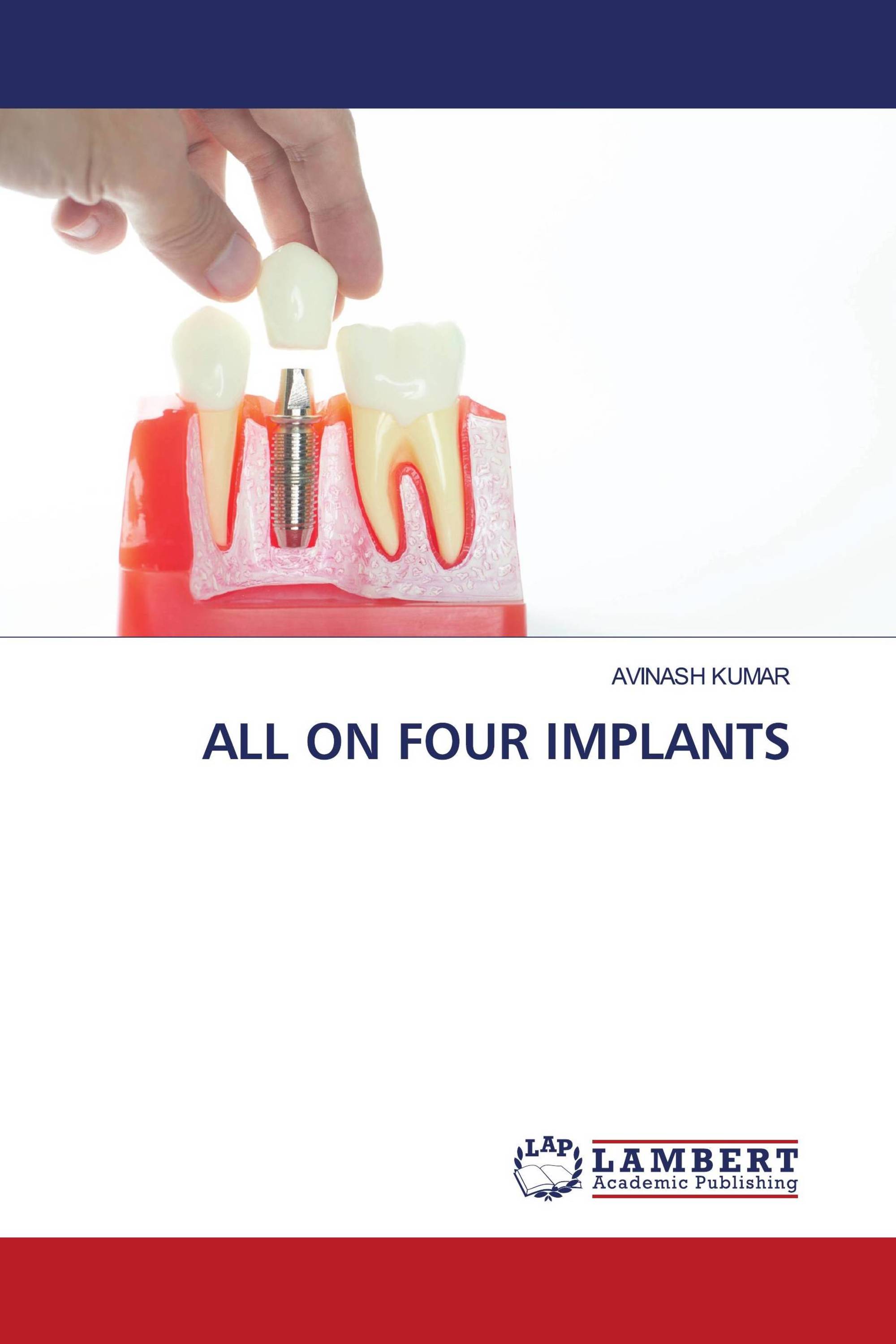 ALL ON FOUR IMPLANTS