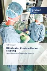 MRI-Guided Prostate Motion Tracking