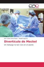 Divertículo de Meckel