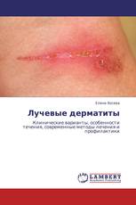 Лучевые дерматиты