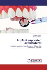 Implant supported overdentures