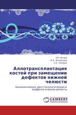 Аллотрансплантация костей при замещении дефектов нижней челюсти