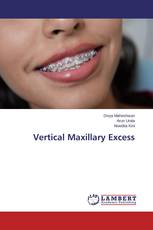 Vertical Maxillary Excess
