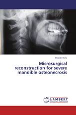 Microsurgical reconstruction for severe mandible osteonecrosis