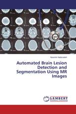 Automated Brain Lesion Detection and Segmentation Using MR Images