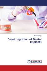 Oseointegration of Dental Implants