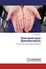 Контрактура Дюпюитрена