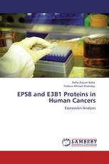 EPS8 and E3B1 Proteins in Human Cancers